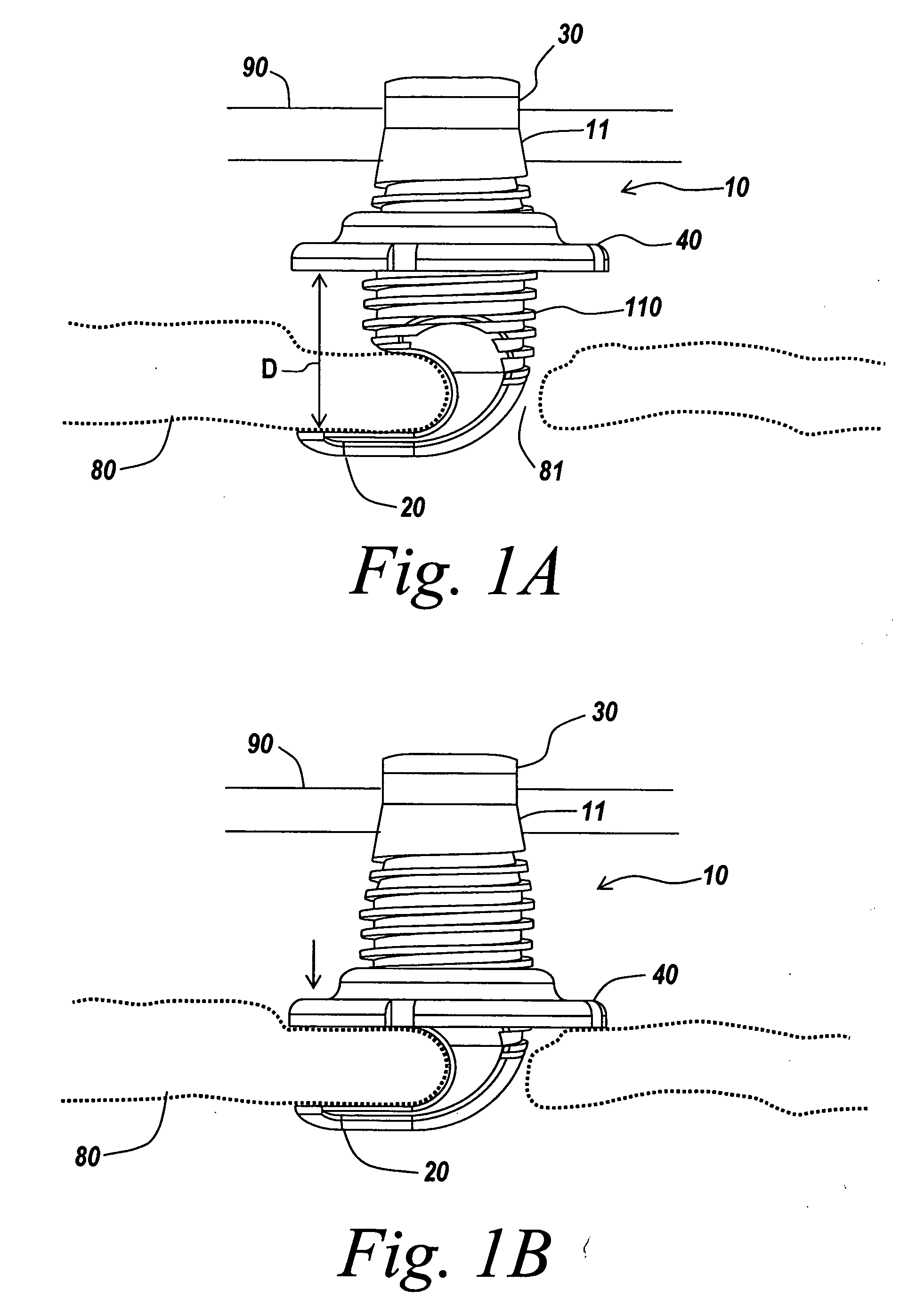 Orthopedic clamping hook assembly