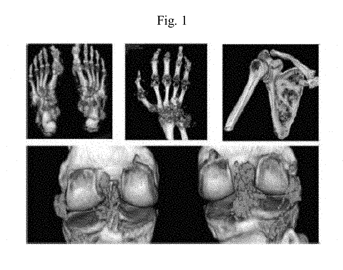 Formulations and doses of pegylated uricase