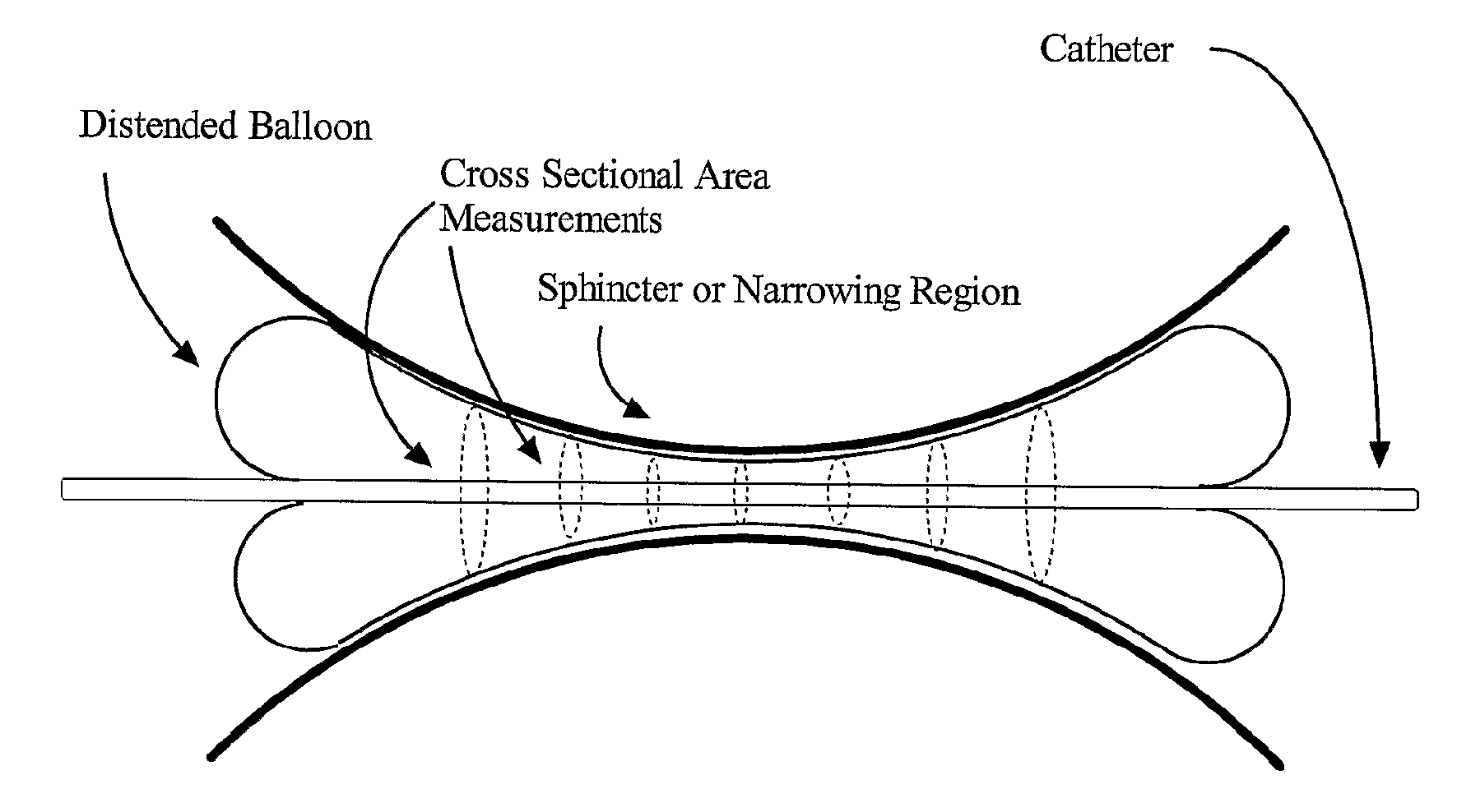 Method and Apparatus For Chemical Measurement of Sphincters and Narrowing Regions in Hollow Biological Organs