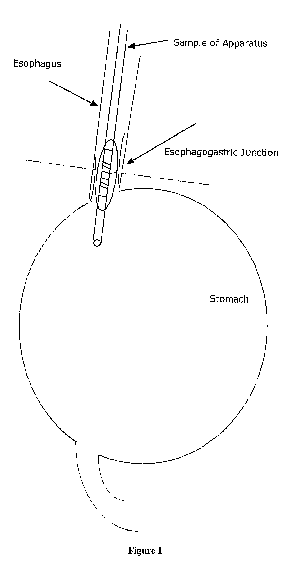 Method and Apparatus For Chemical Measurement of Sphincters and Narrowing Regions in Hollow Biological Organs