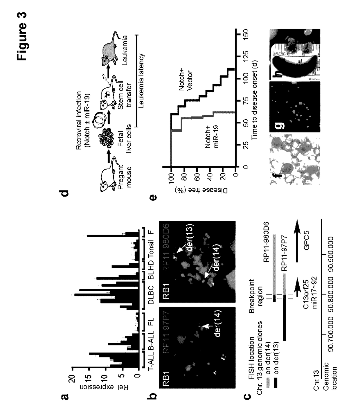 Methods and compositions for the detection and treatment of cancer involving miRNAs and miRNA inhibitors and targets