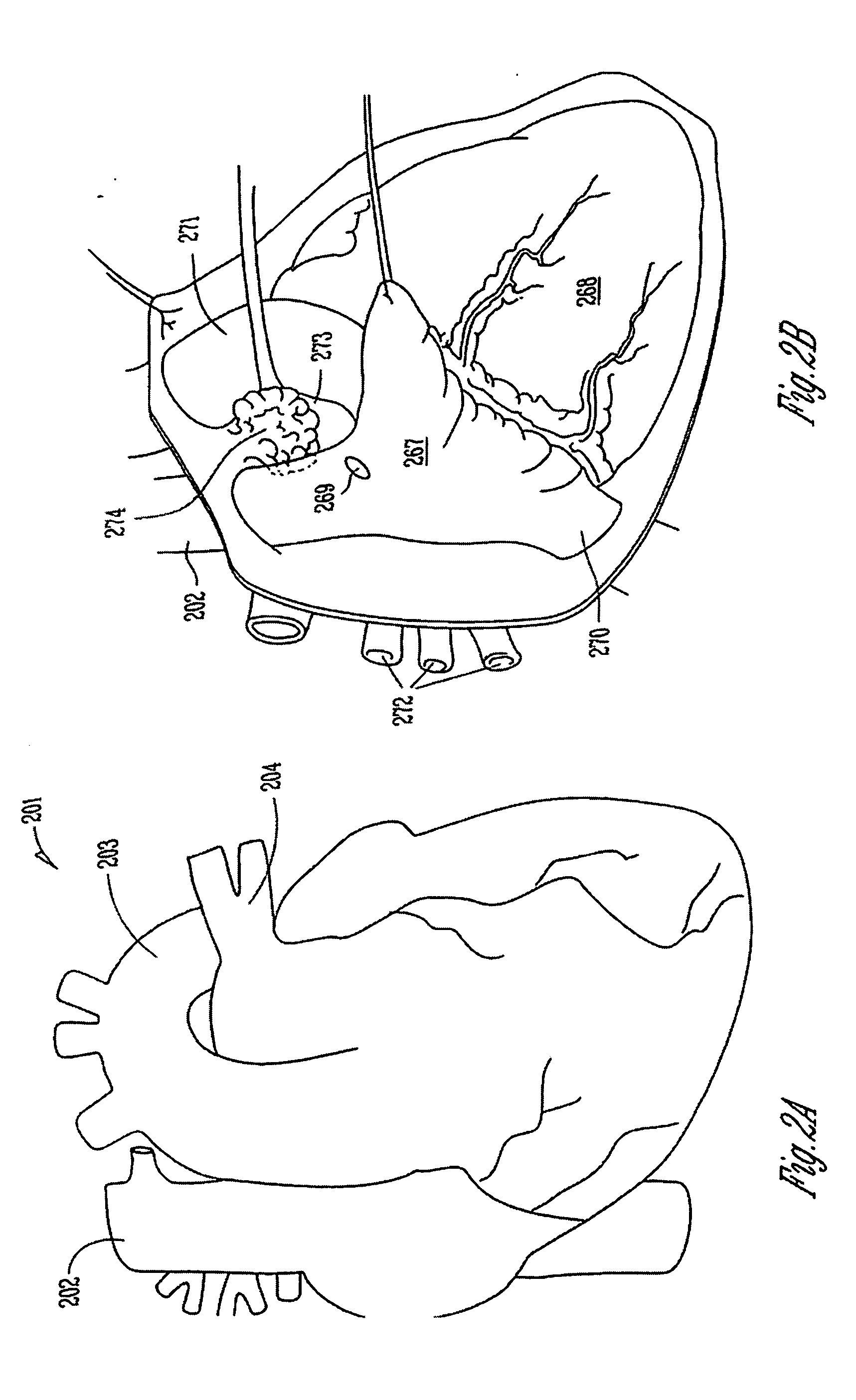 Coordinated therapy for disordered breathing including baroreflex modulation