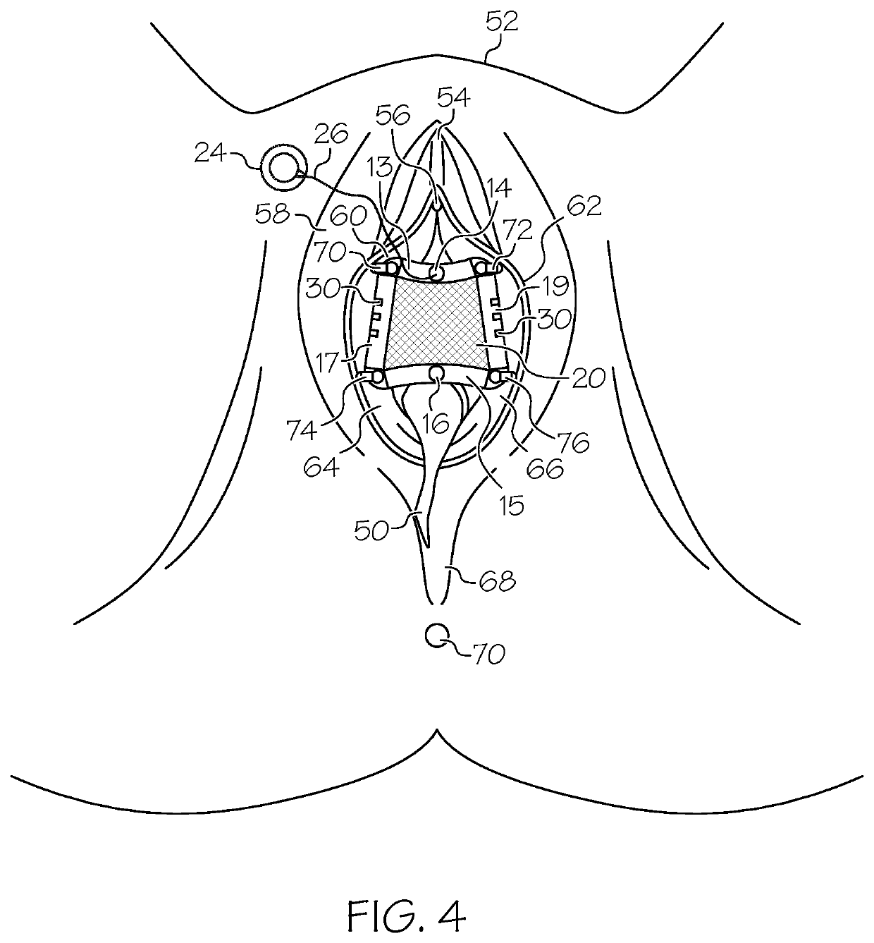 Retractor for vaginal repair