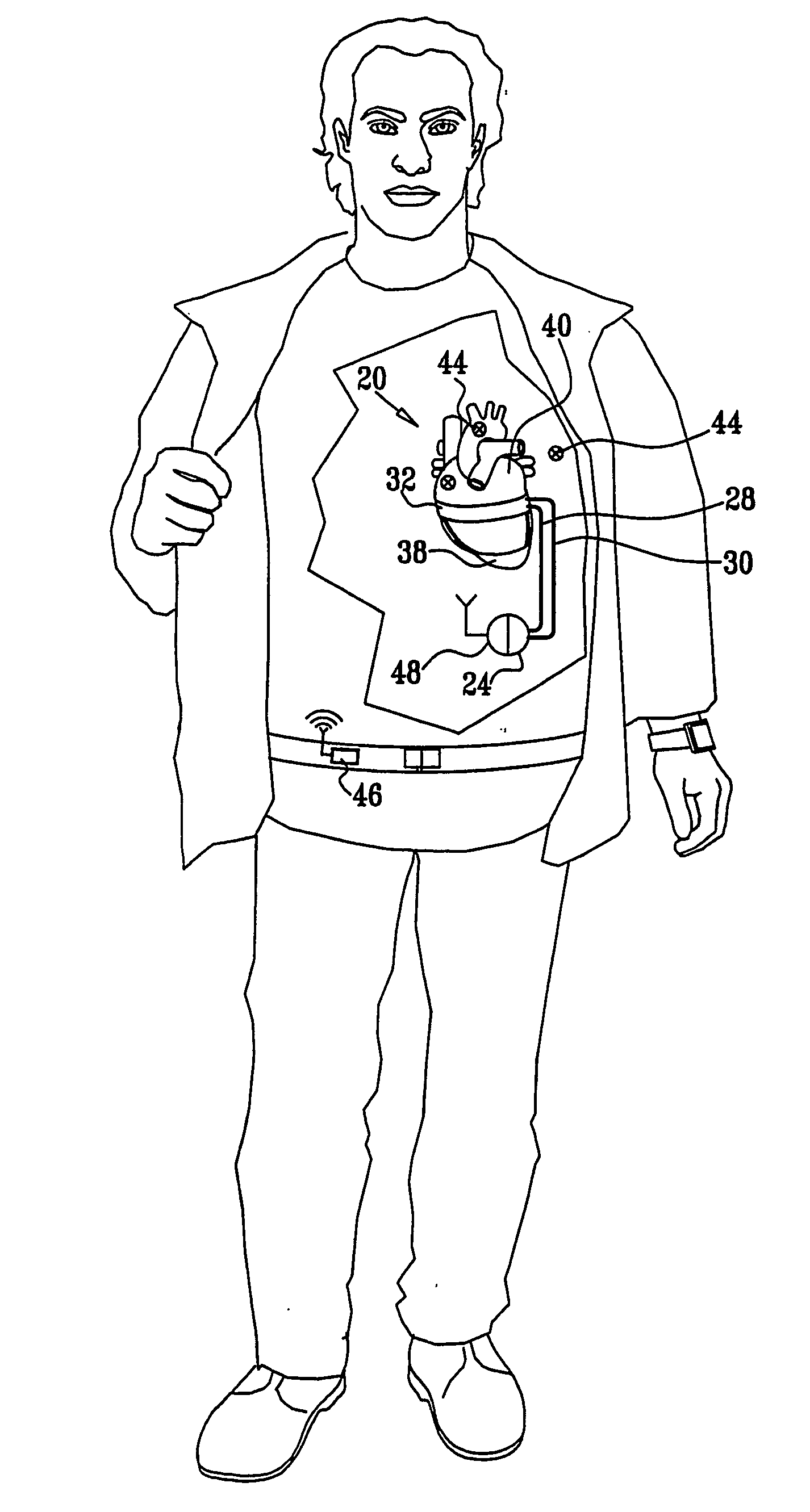 Amplification-Based Cardiac Assist Device