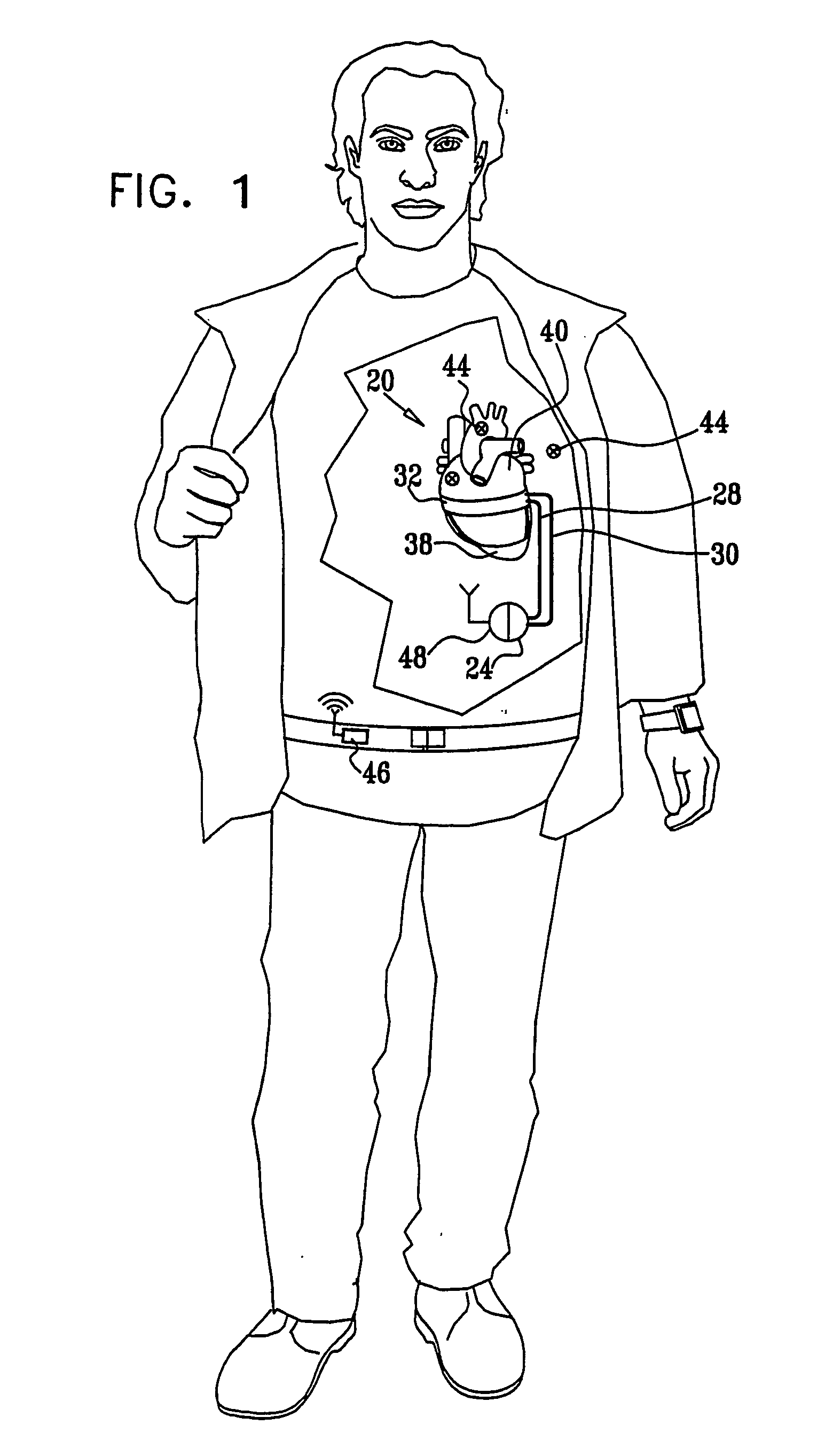 Amplification-Based Cardiac Assist Device