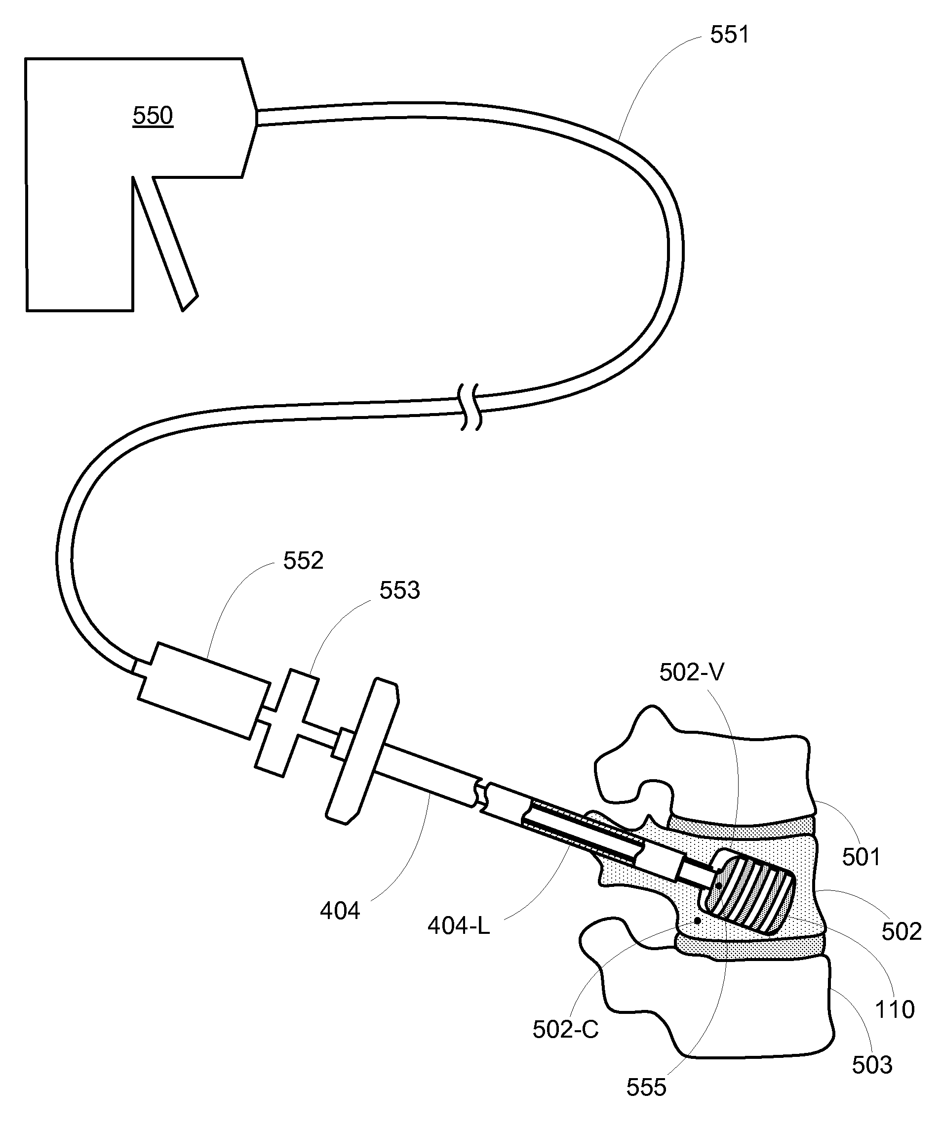 Expandable device for bone manipulation