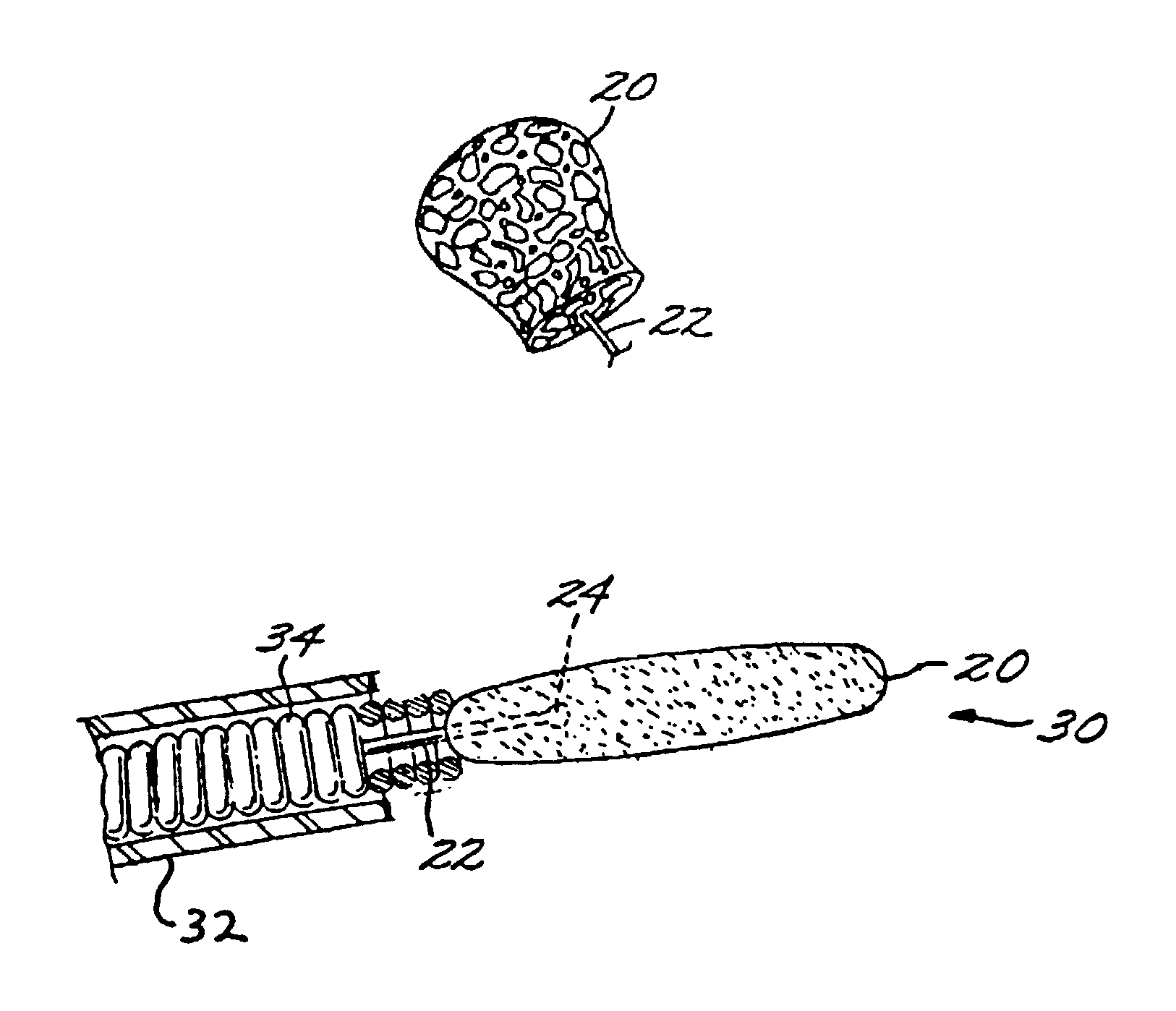 Vascular embolization with an expansible implant