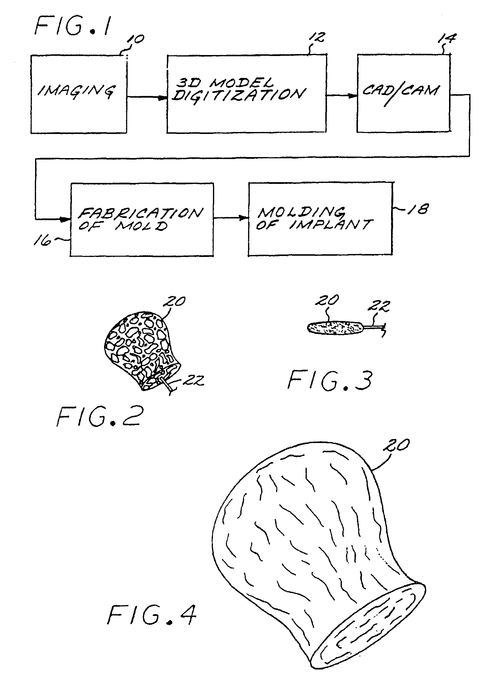 Vascular embolization with an expansible implant