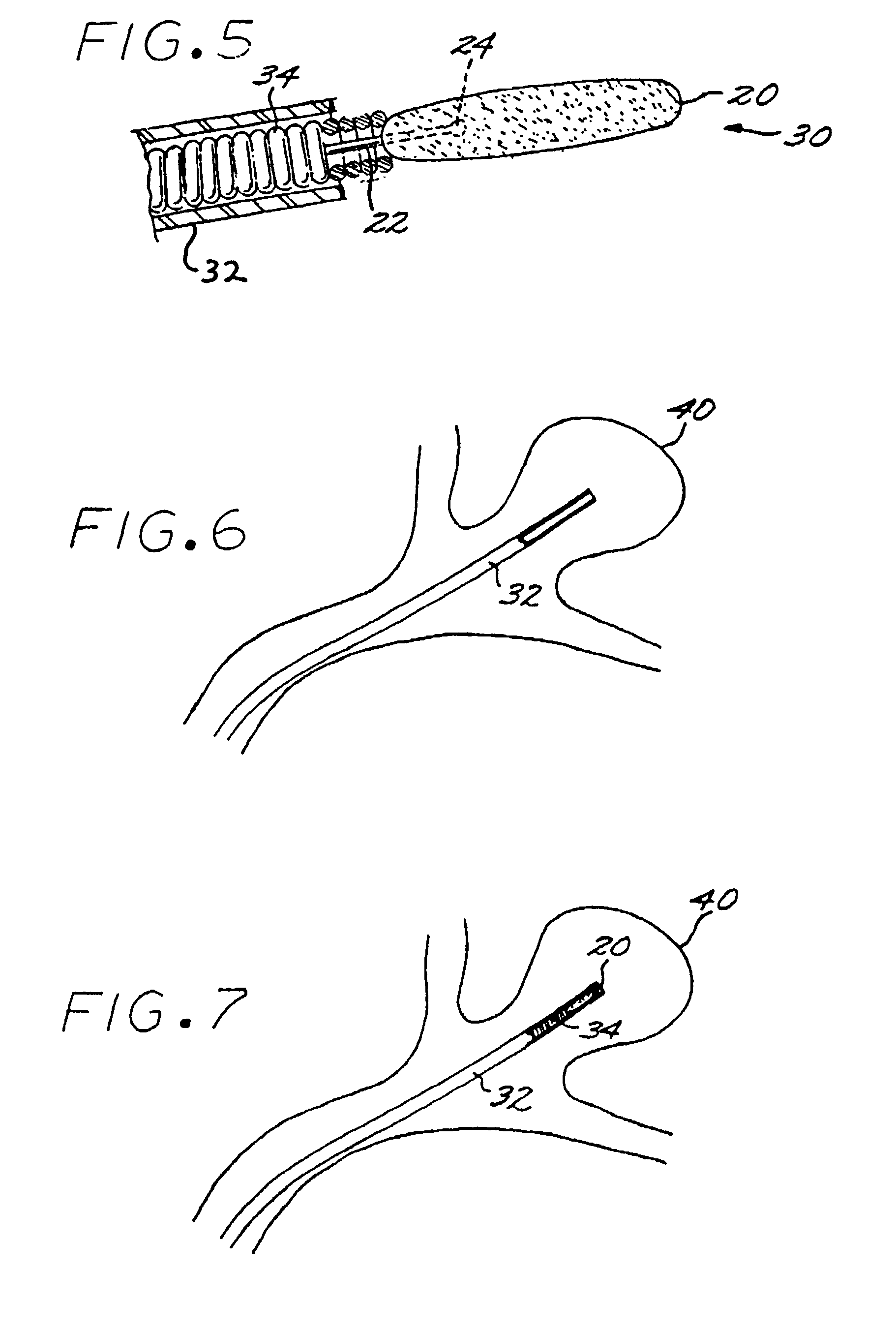 Vascular embolization with an expansible implant