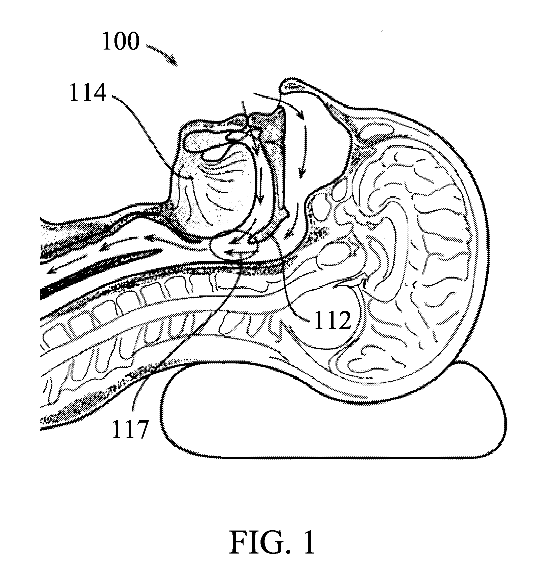 Snoring and obstructive sleep apnea prevention and treatment device