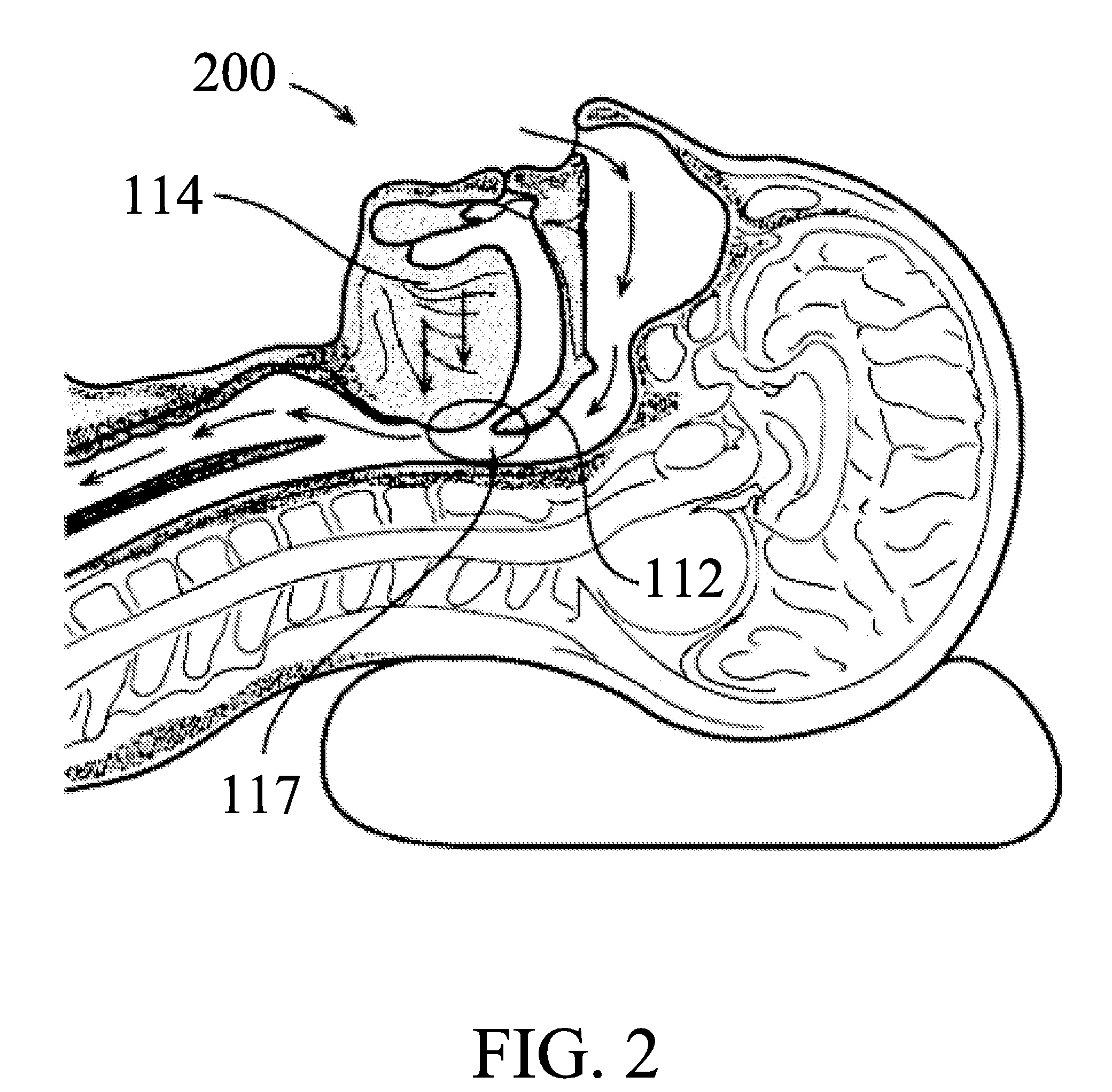 Snoring and obstructive sleep apnea prevention and treatment device