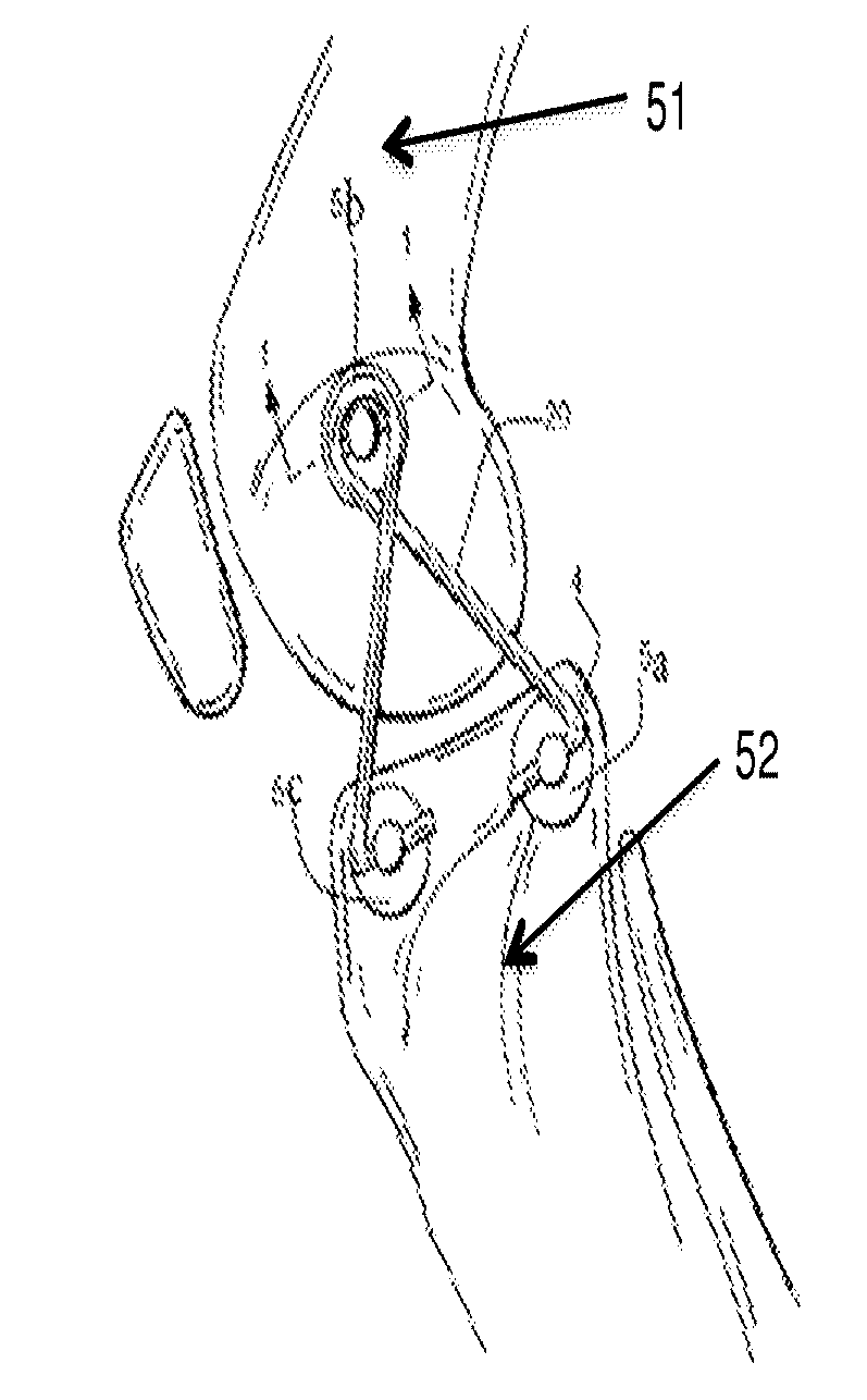 Internal joint bracing system and suture anchoring assembly therefore