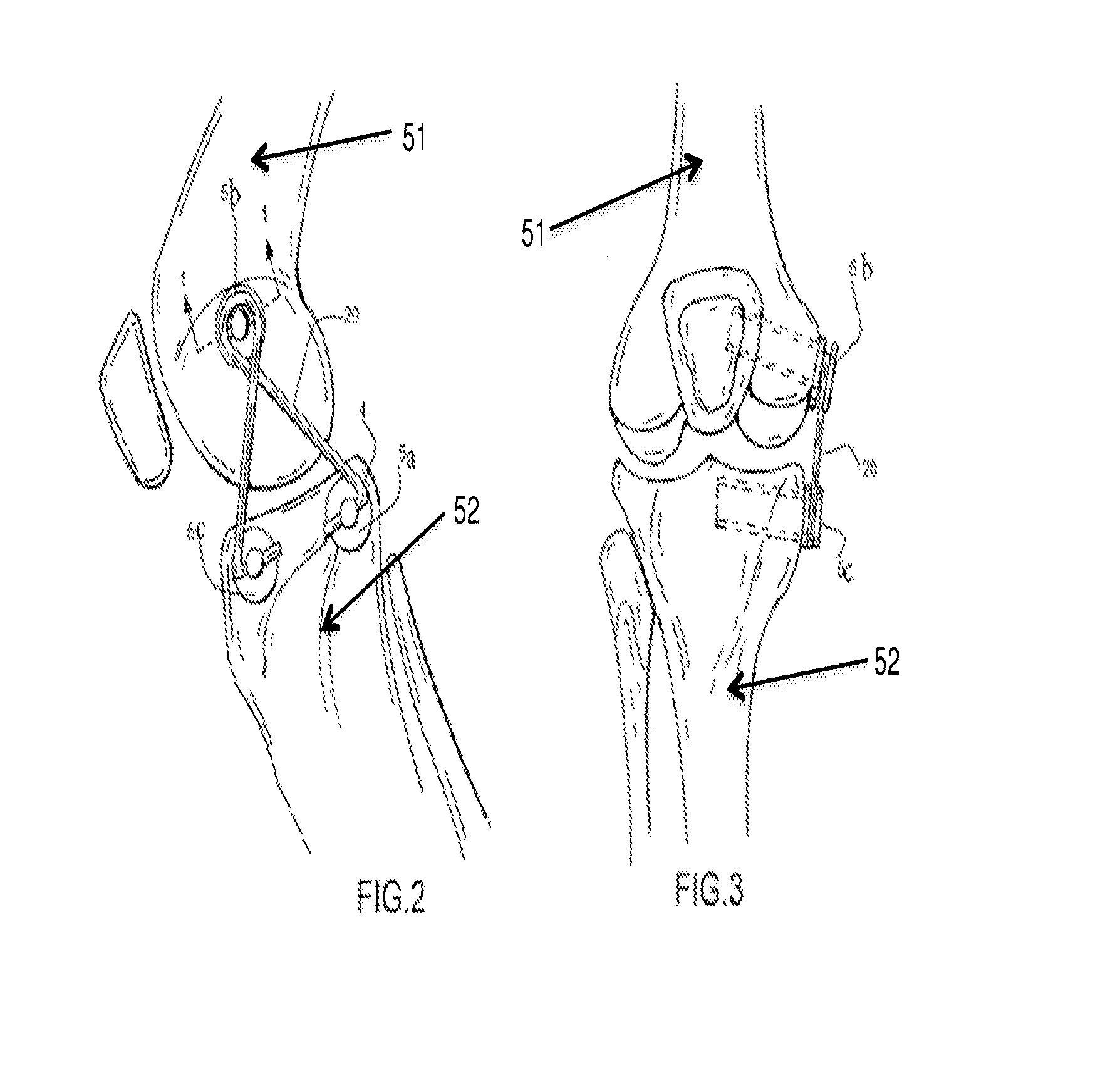 Internal joint bracing system and suture anchoring assembly therefore