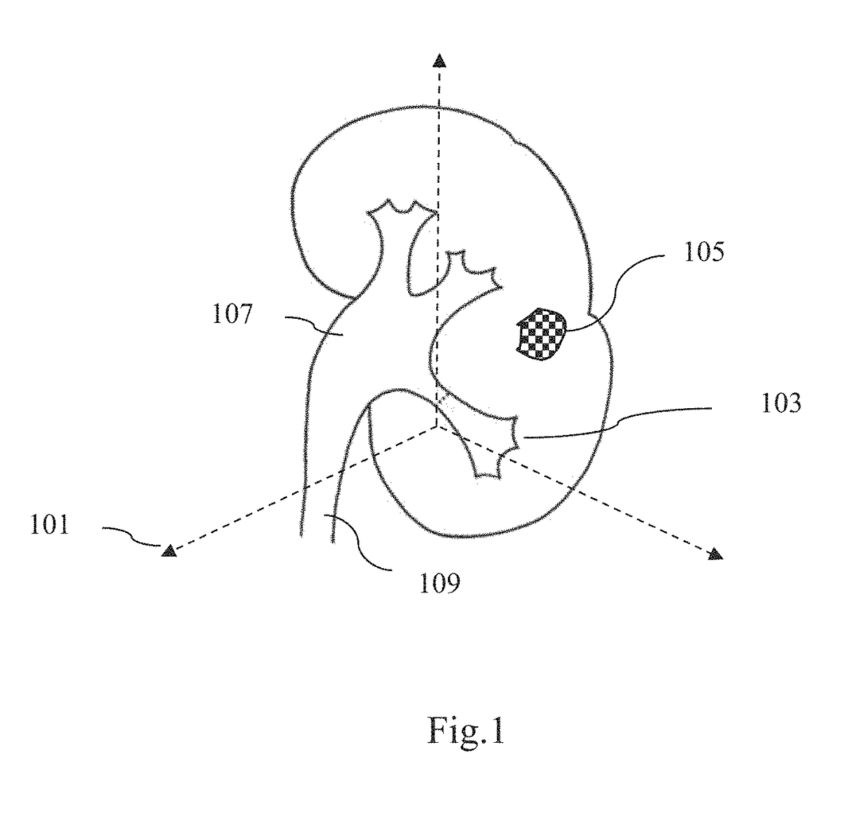 Method and system for interactive grid placement and measurements for lesion removal