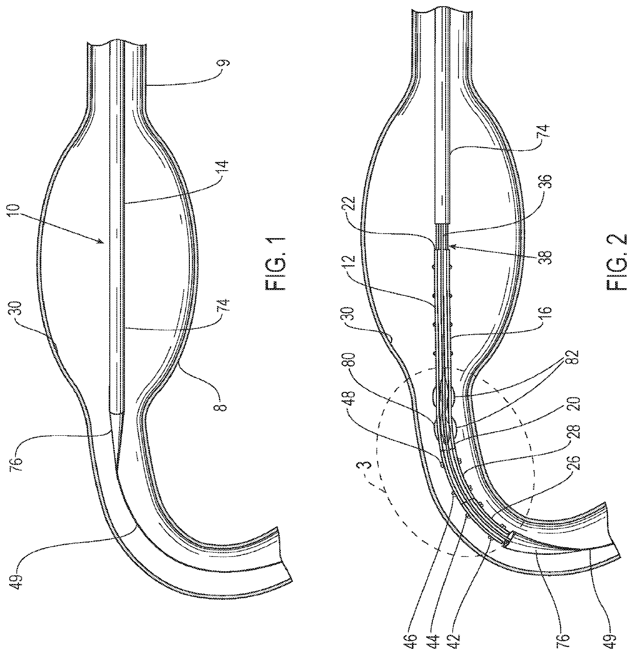 Balloon assisted endoluminal prosthesis deployment