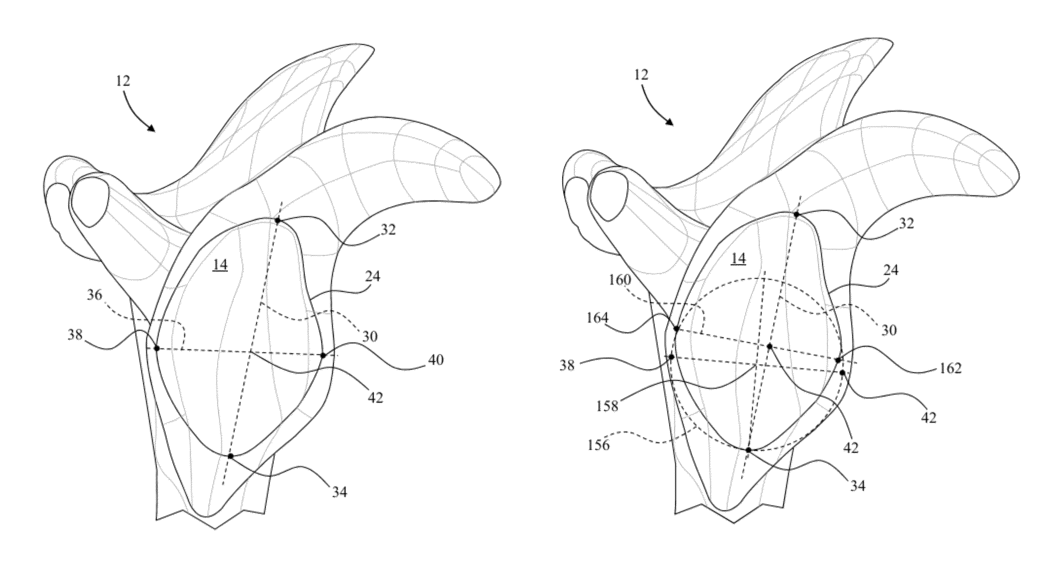 Circular glenoid method for shoulder arthroplasty