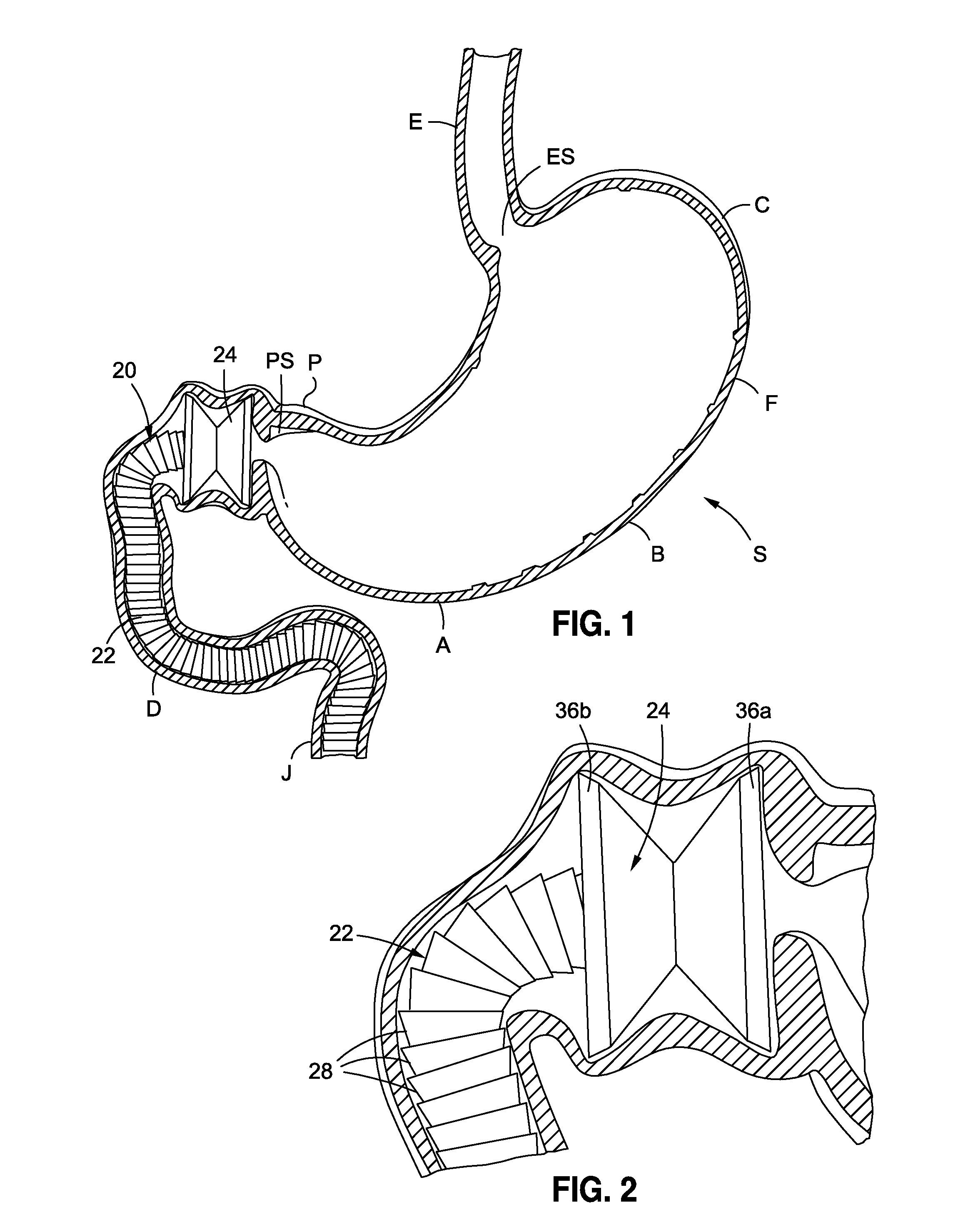 Anchored non-piercing duodenal sleeve and delivery systems