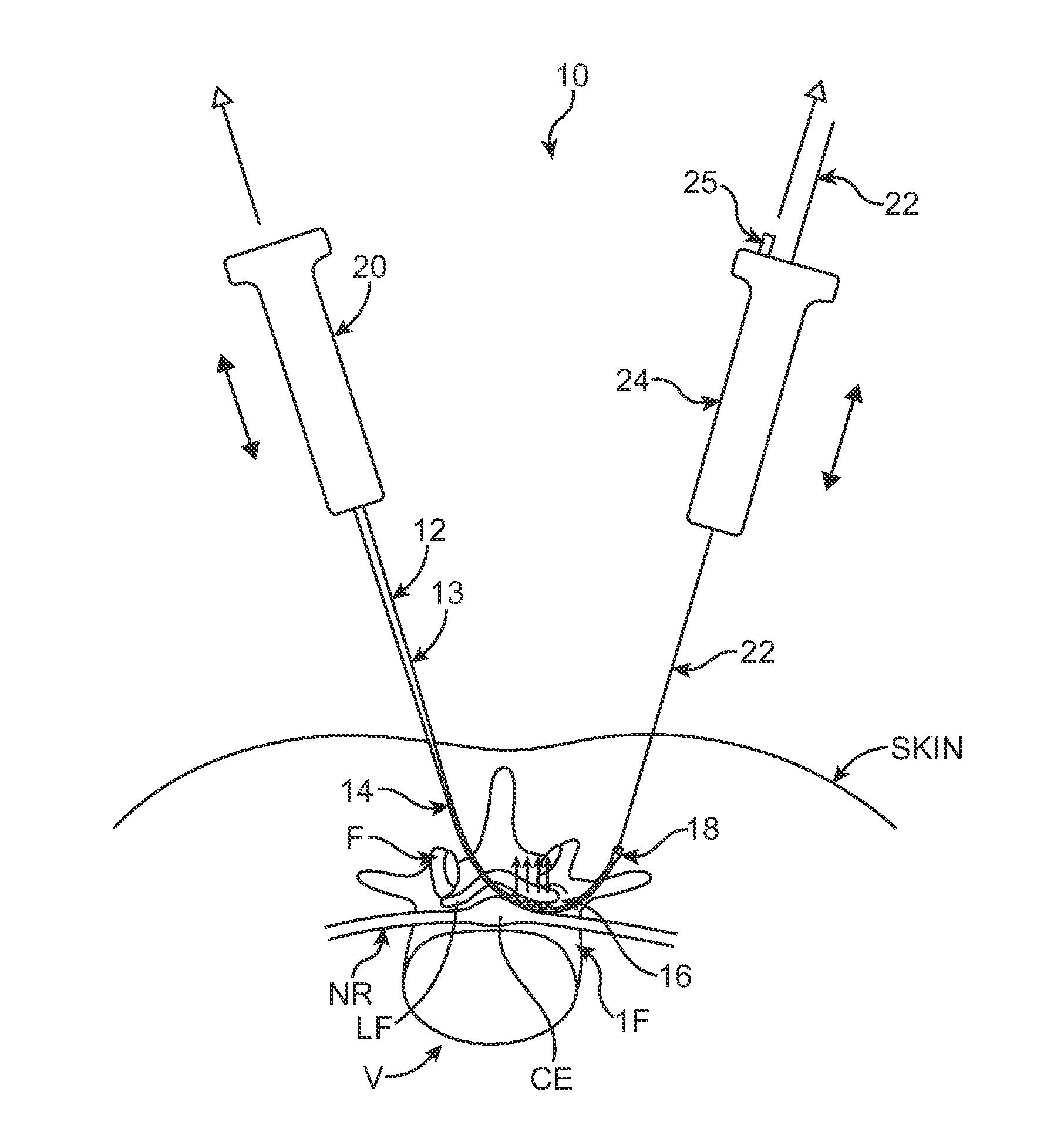 Methods, systems and devices for carpal tunnel release