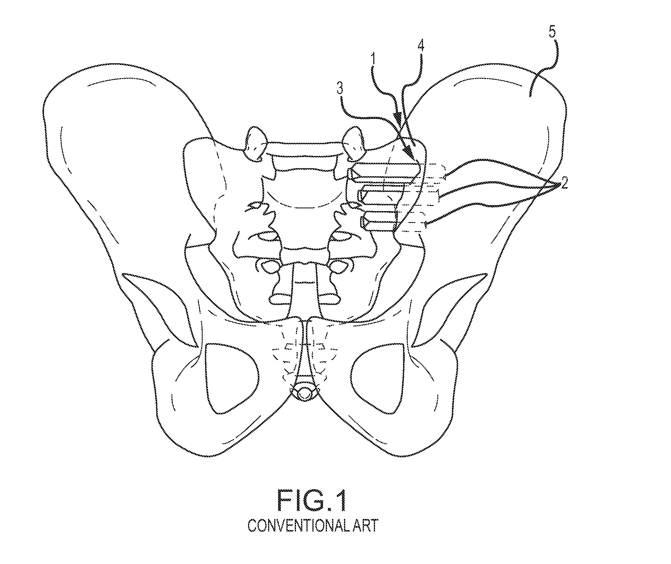 Systems for and methods of fusing a sacroiliac joint