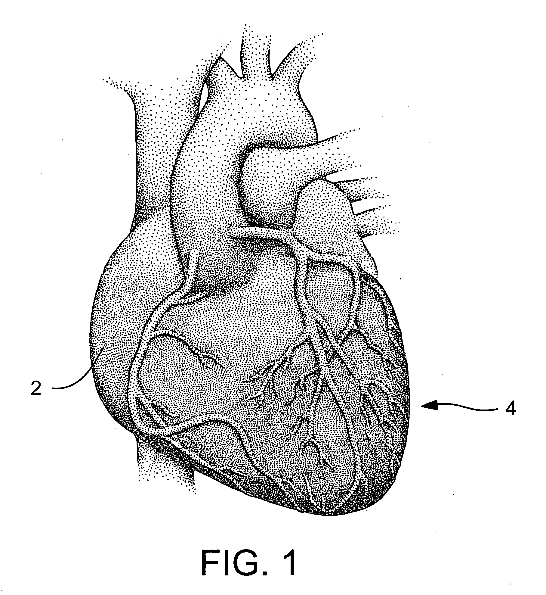 Small vessel stent designs