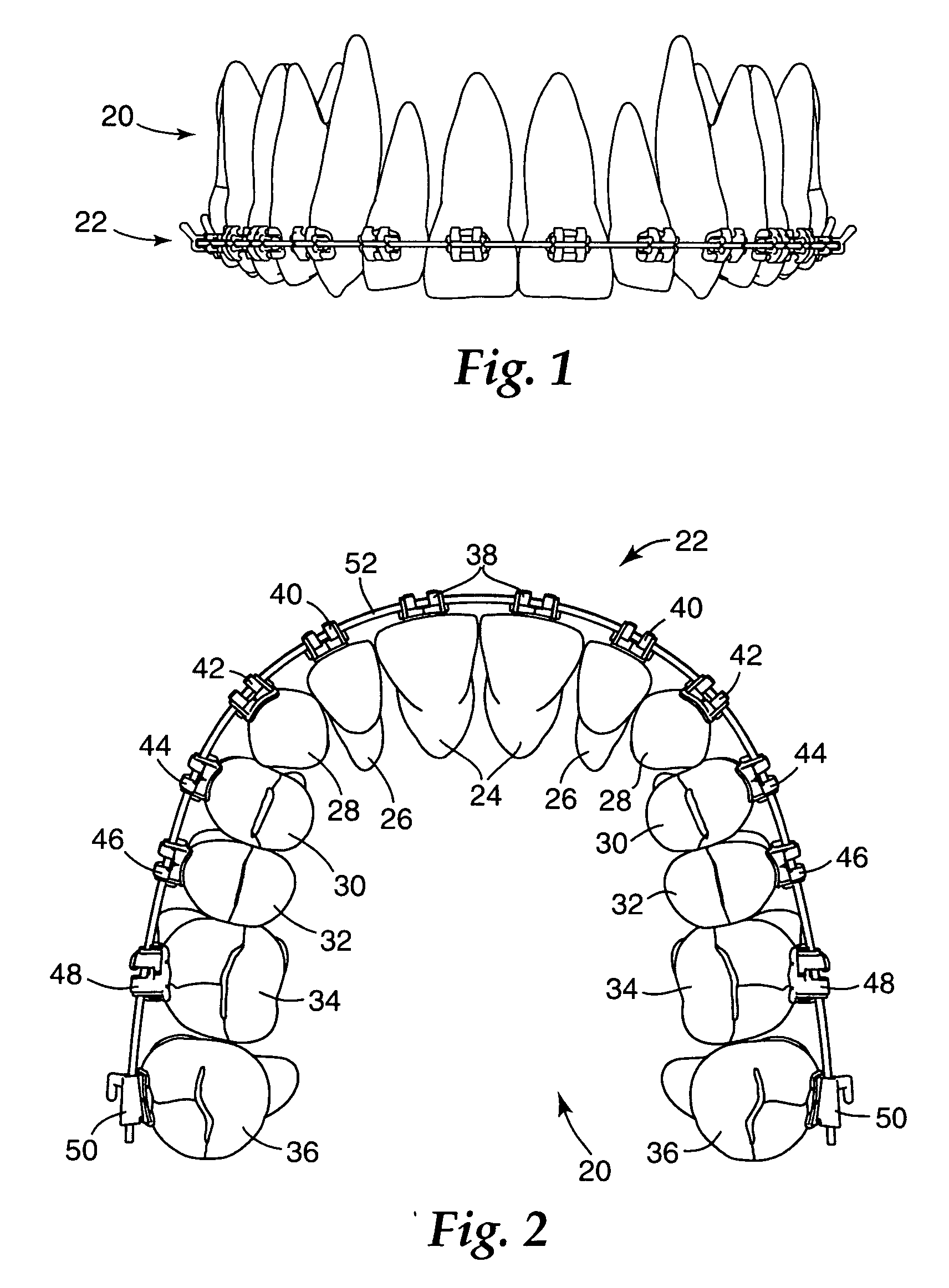 Molar appliance for an orthodontic brace