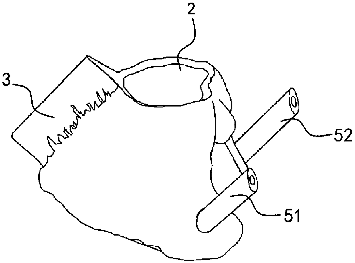 Trigeminal ganglion injection guide plate as well as preparation method and application thereof