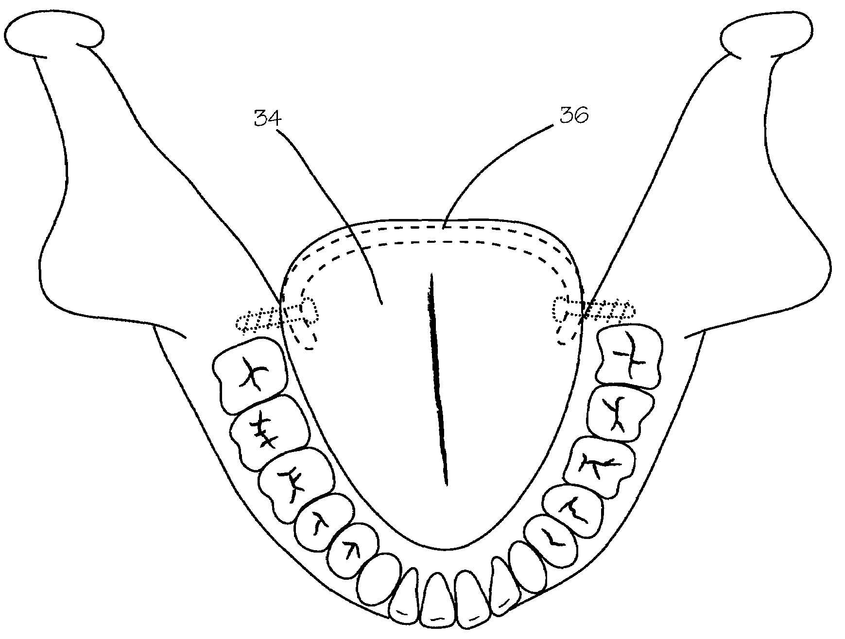 Method and device for treatment of obstructive sleep apnea