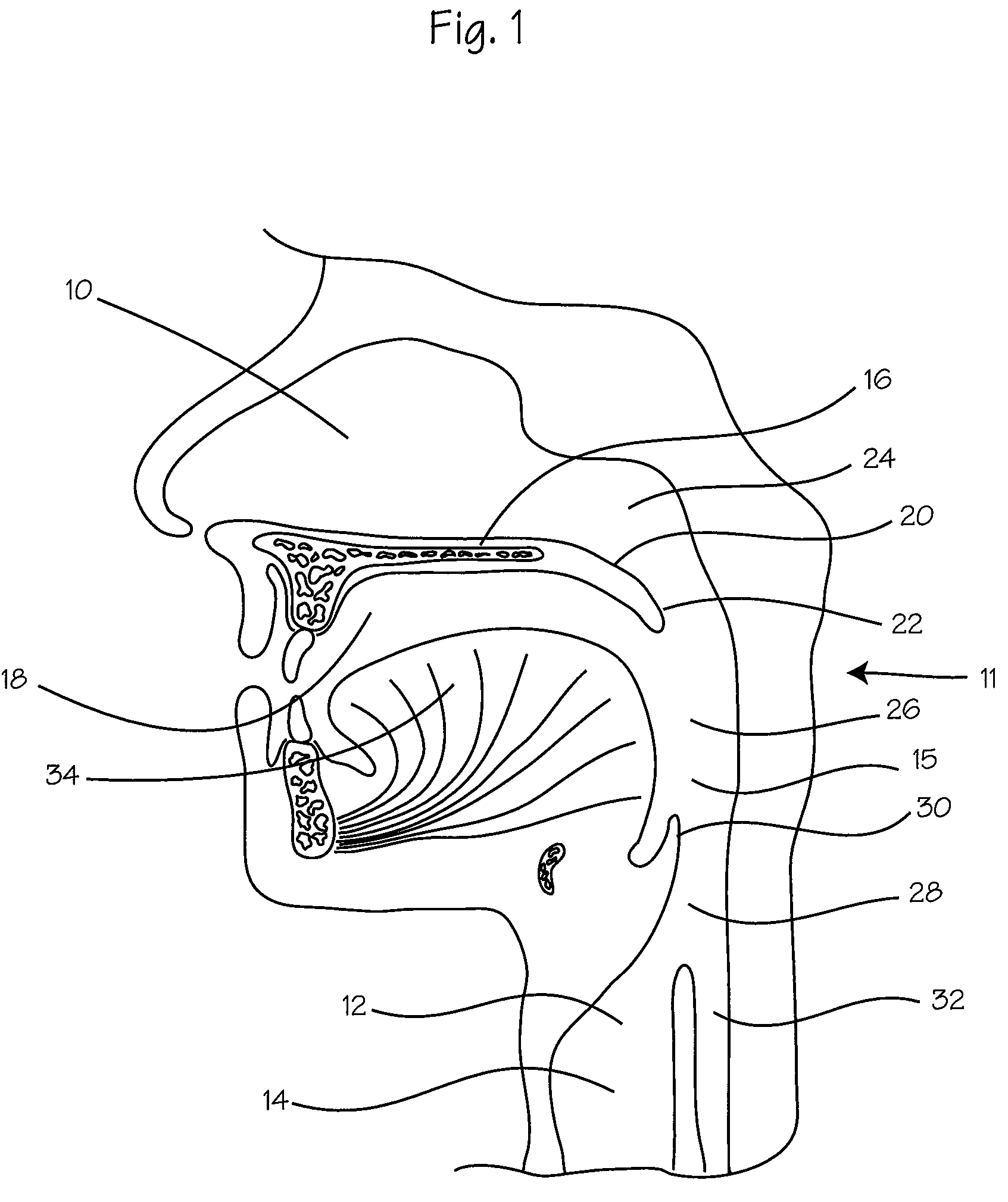 Method and device for treatment of obstructive sleep apnea