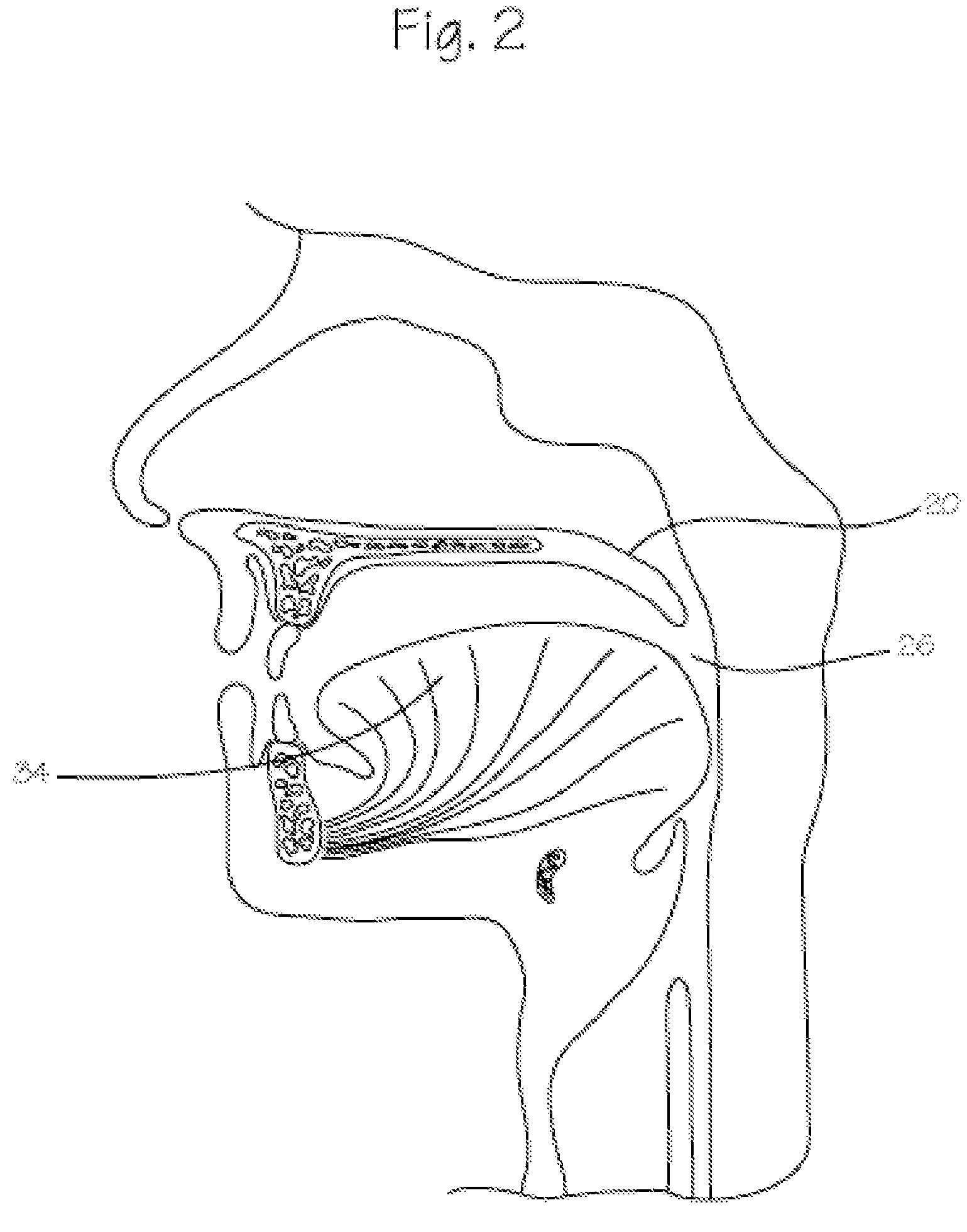 Method and device for treatment of obstructive sleep apnea