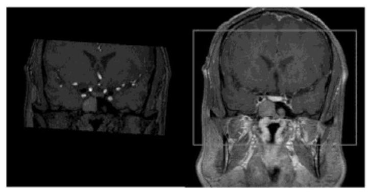 Intracranial vascular focus identification method based on transfer learning