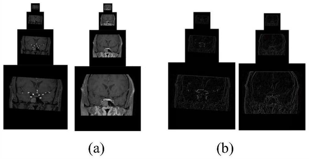 Intracranial vascular focus identification method based on transfer learning