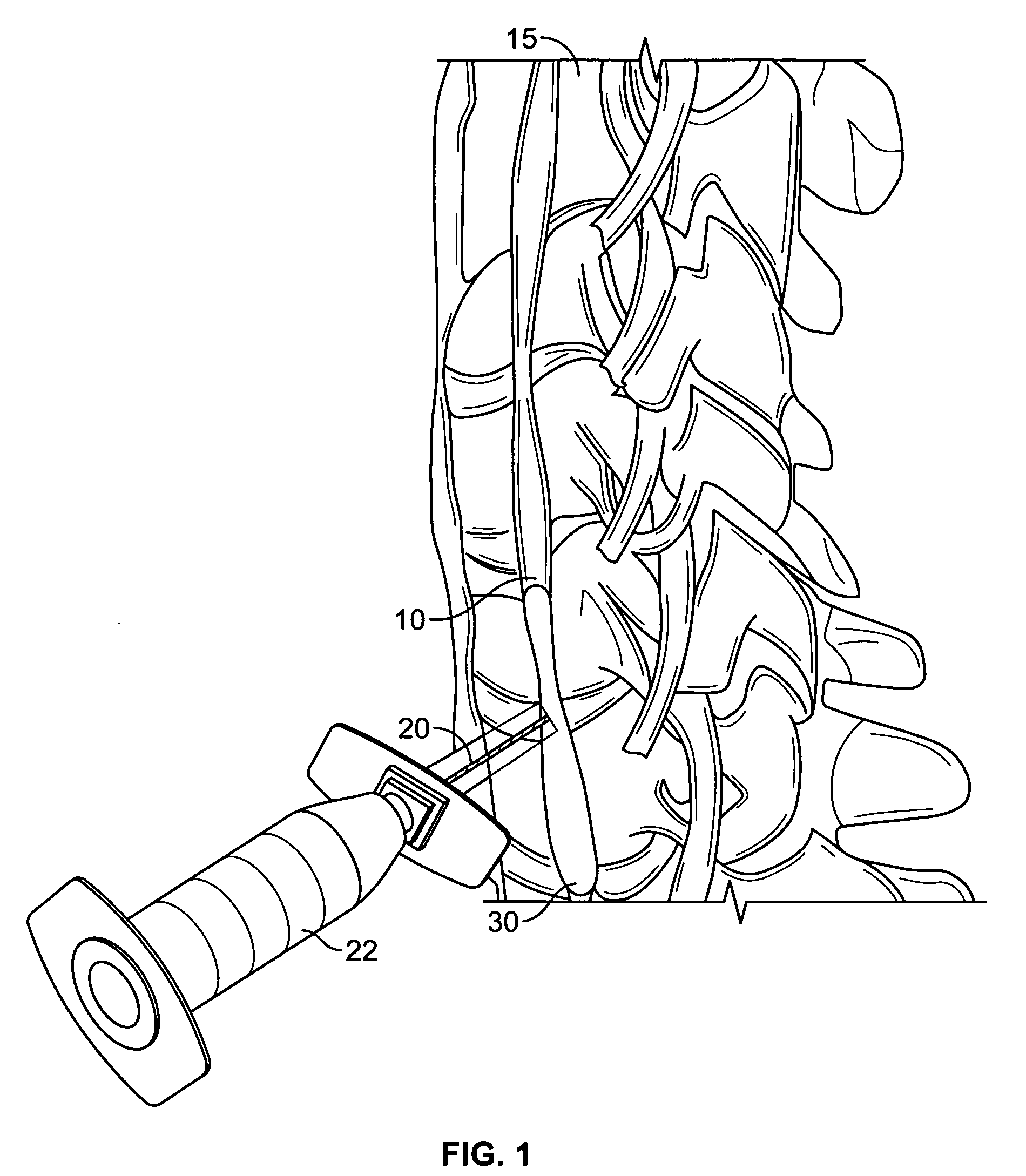 Use of stellate ganglion block for the treatment of hot flashes and other conditions