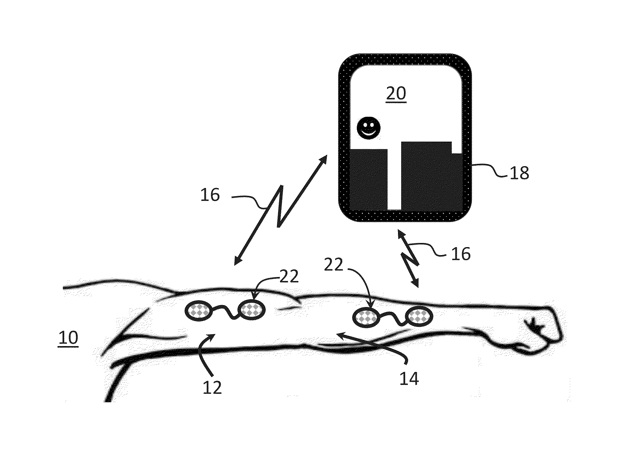 Gamified electromyographic neuromuscular reeducation therapy system