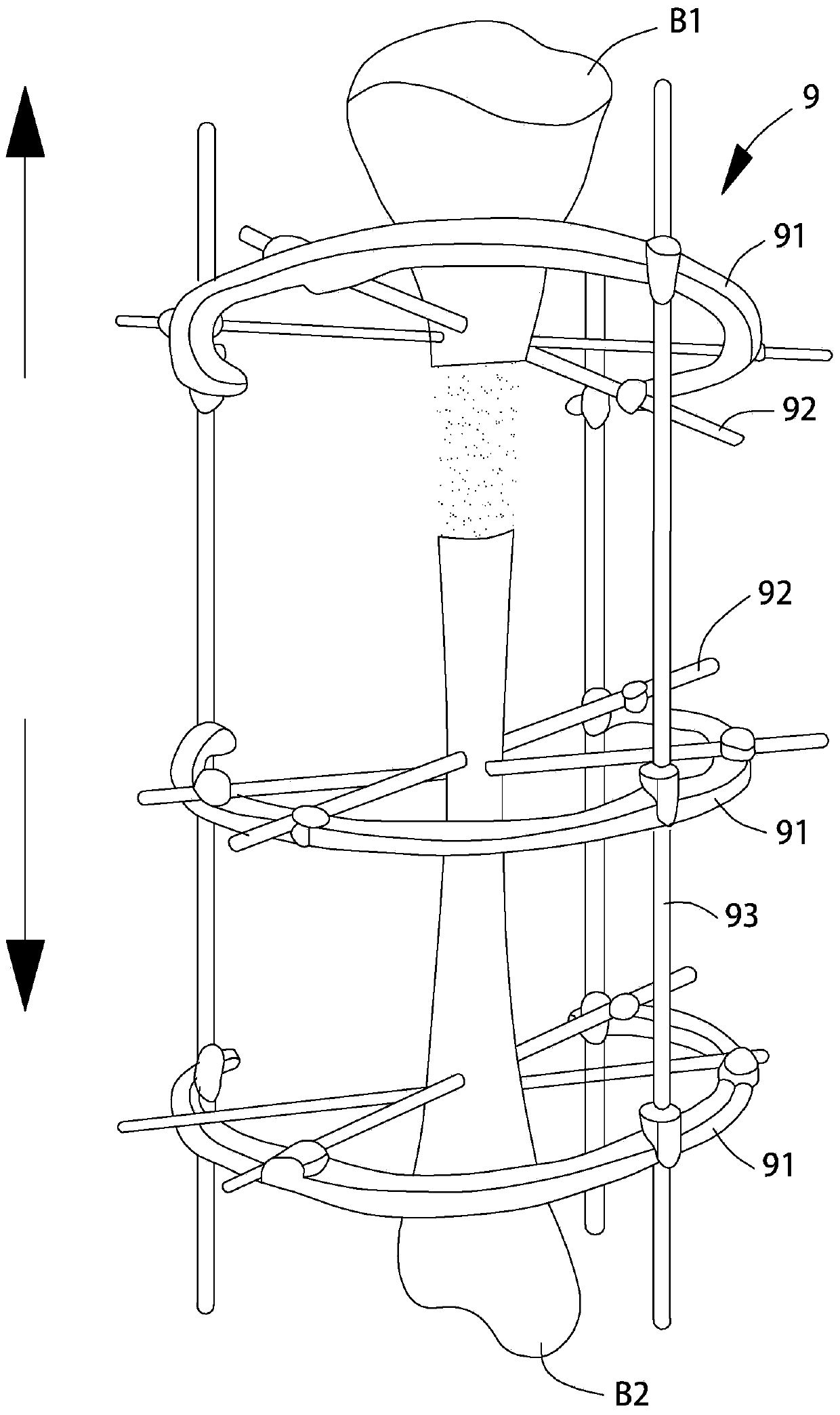 External fixator and its adjustment components