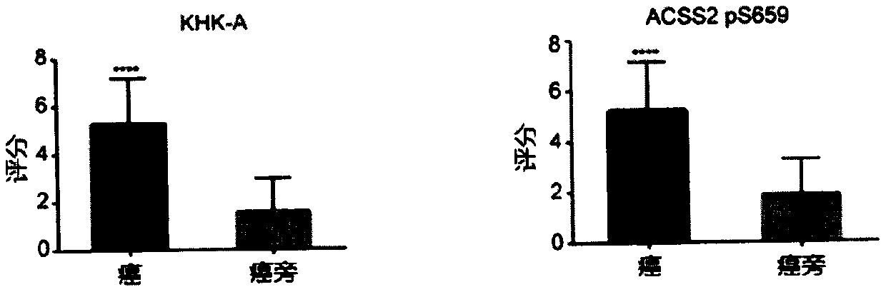 Prognostic prediction method for non-small cell lung cancer