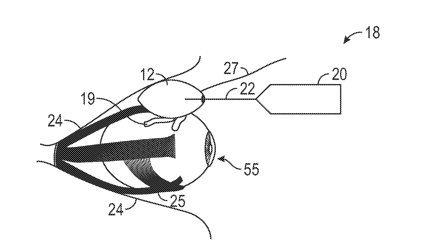 Retinal repair device and method