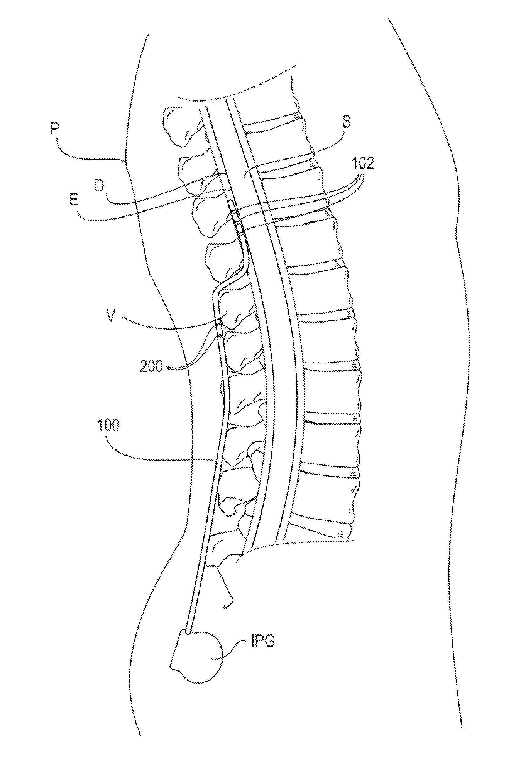 Twist-grip anchors and methods of use