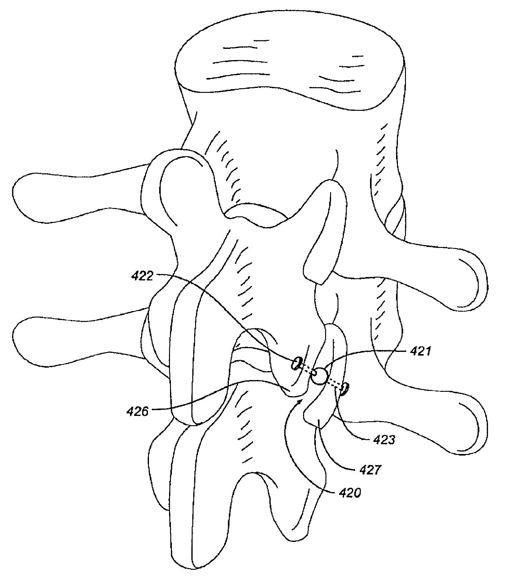 Facet device and method