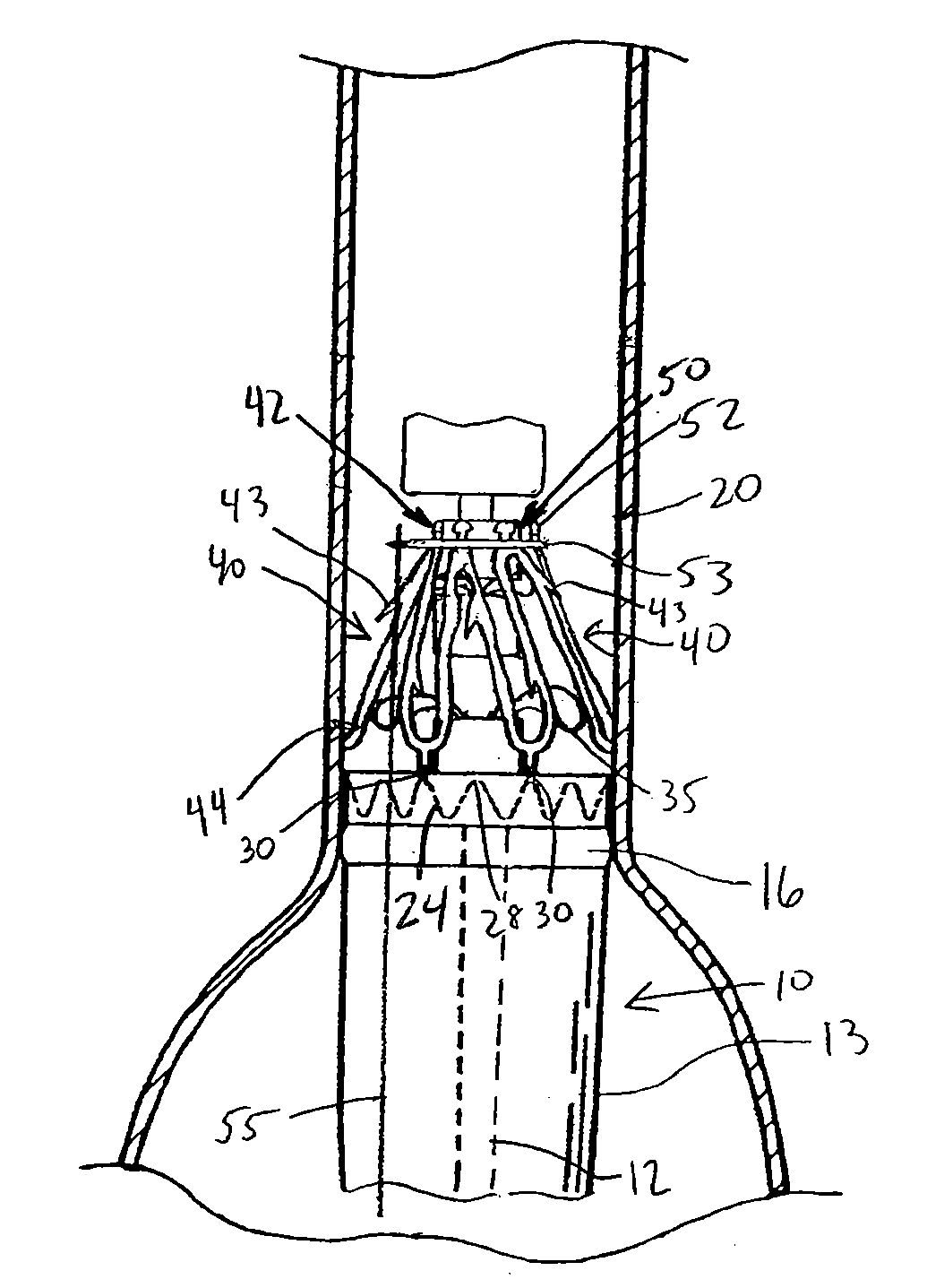 System and method of pivoted stent deployment