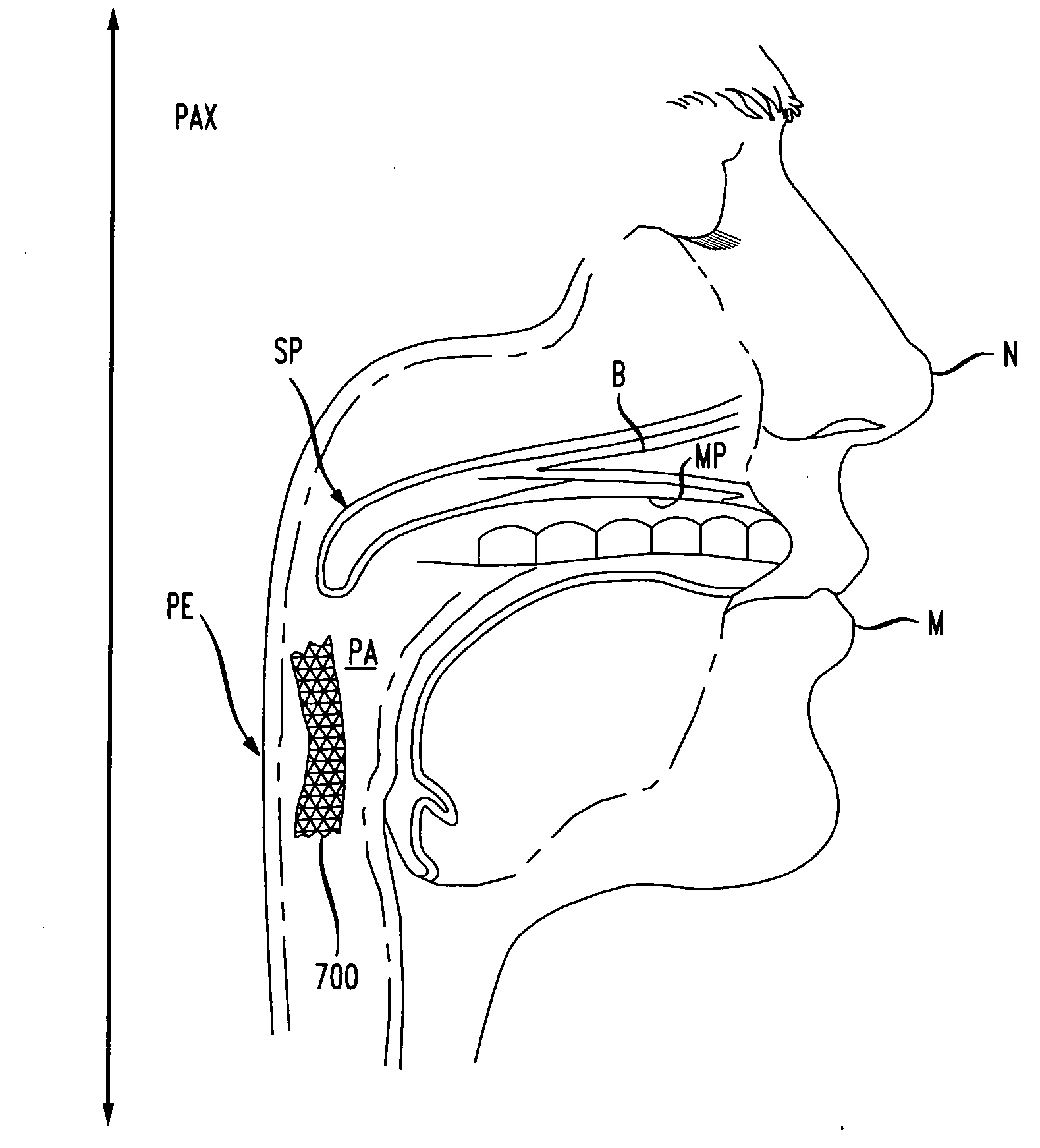 Methods and devices for treatment of obstructive sleep apnea