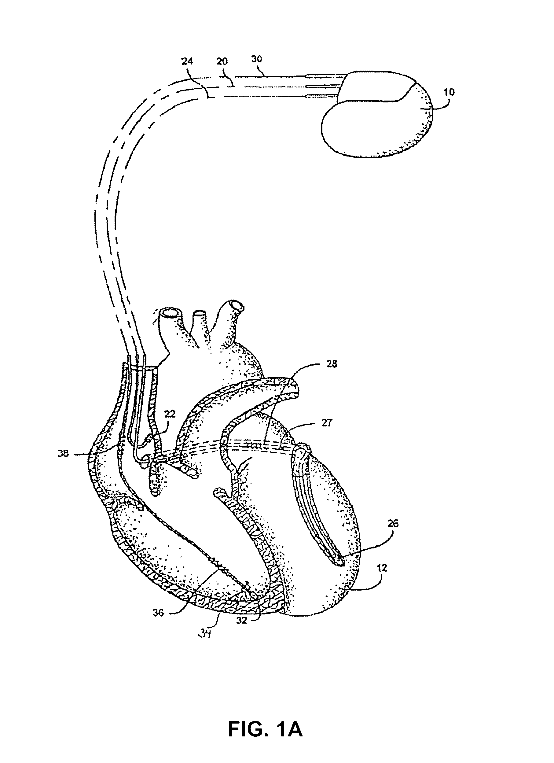 Methods and devices for determining heart rate recovery