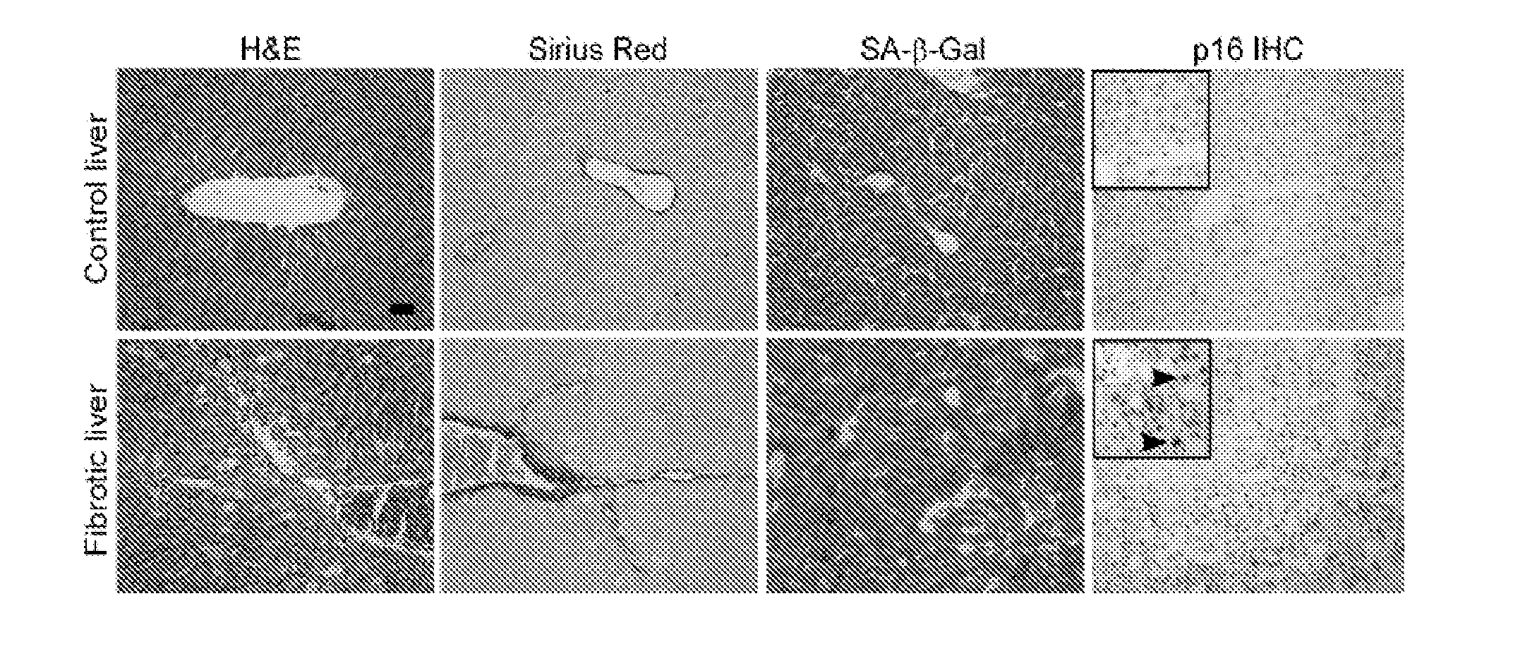 Methods for treating fibrosis by modulating cellular senescence