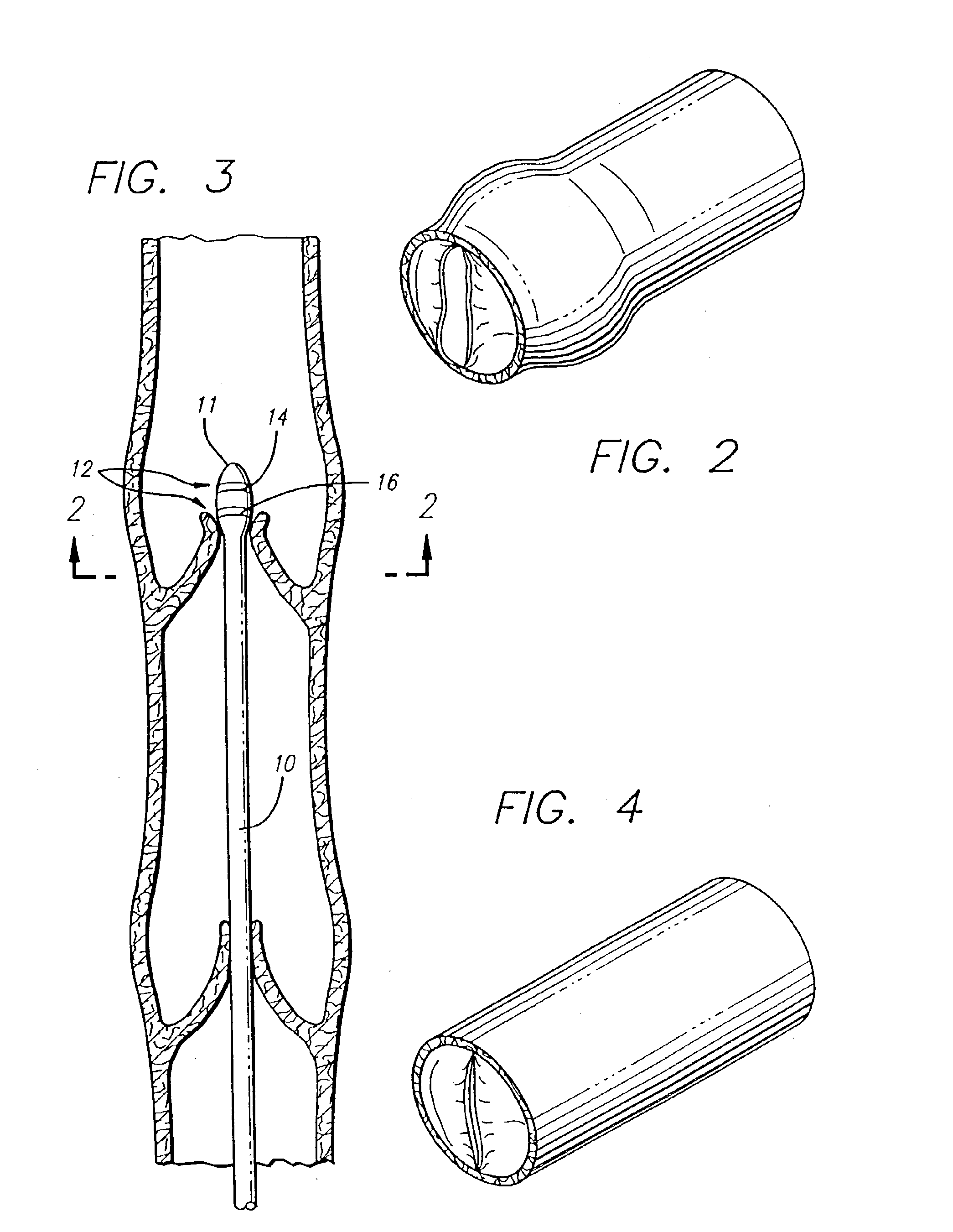 Apparatus for treating venous insufficiency