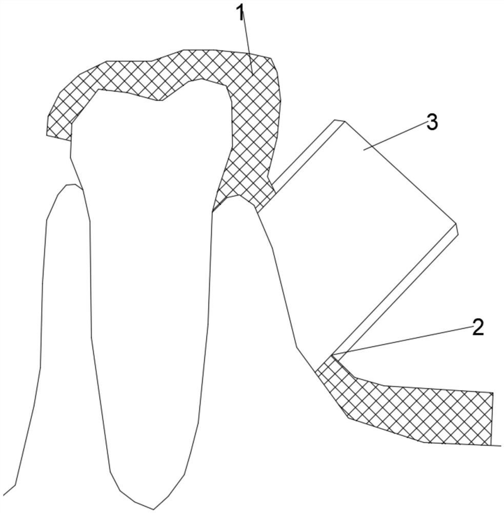 Guide plate for periodontal surgery and preparation method