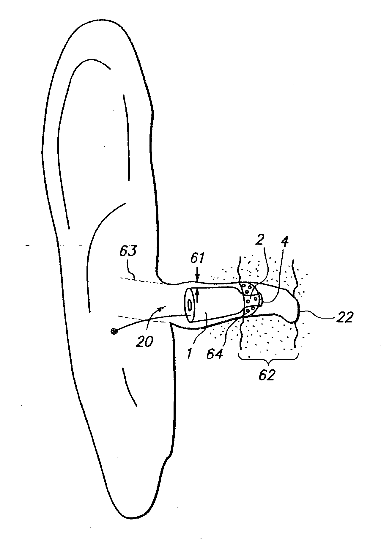 Open fit canal hearing device