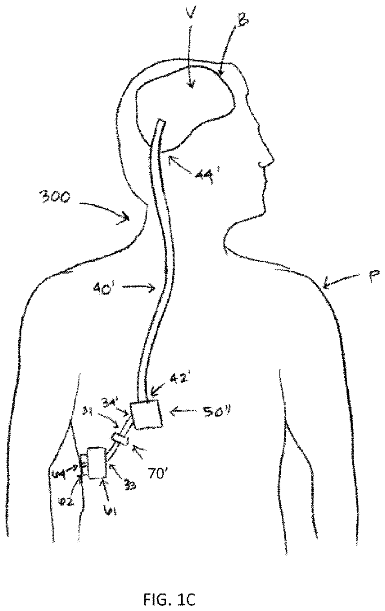 Therapeutic applications of artificial cerebrospinal fluid and tools provided therefor