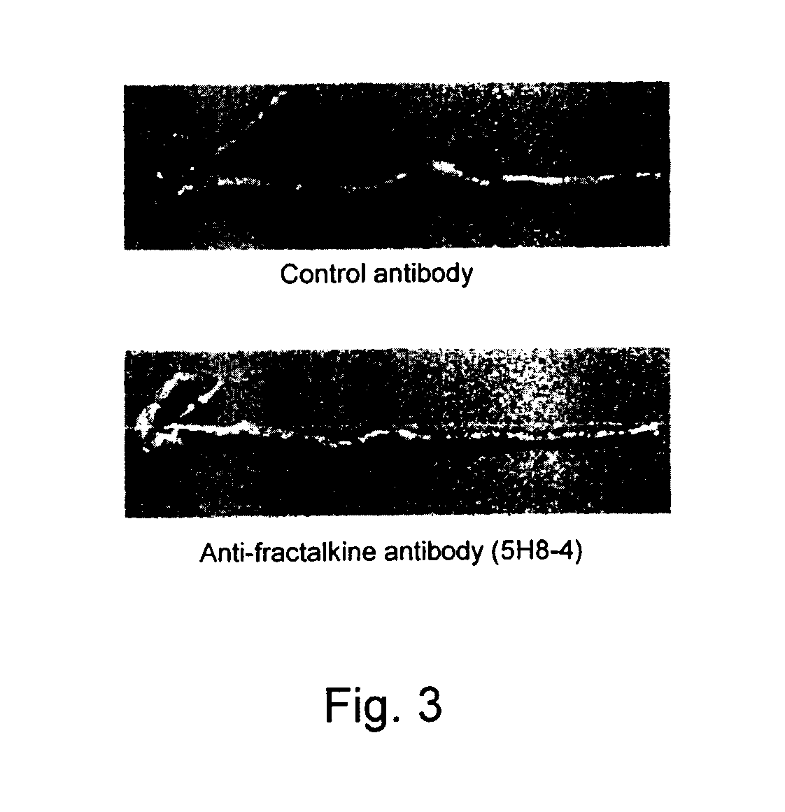 Treating inflammatory diseases with antibodies that inhibit fractalkine-CXCR1 interaction