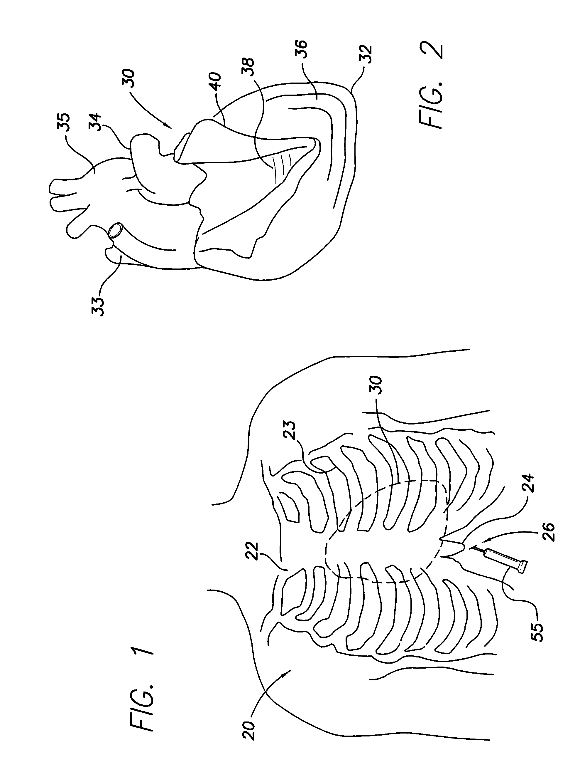 Intrapericardial lead with distal region configured to optimize lead extraction