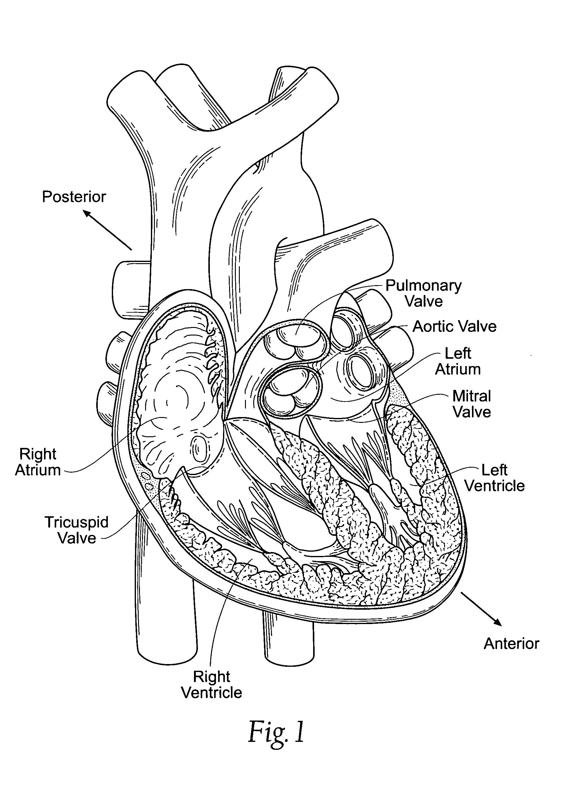 Devices, systems, and methods for supplementing, repairing, or replacing a native heart valve leaflet