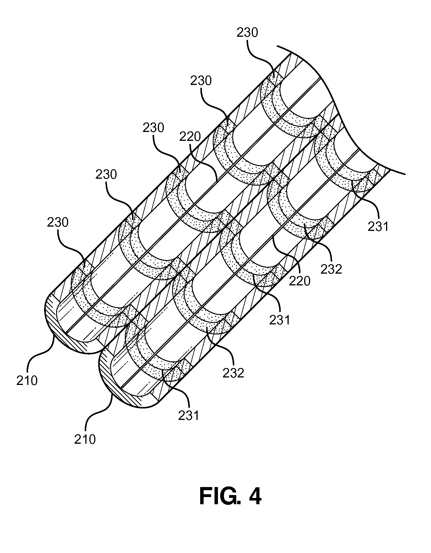 Subcutaneous Dialysis Catheter with Ultrasound  Agitation